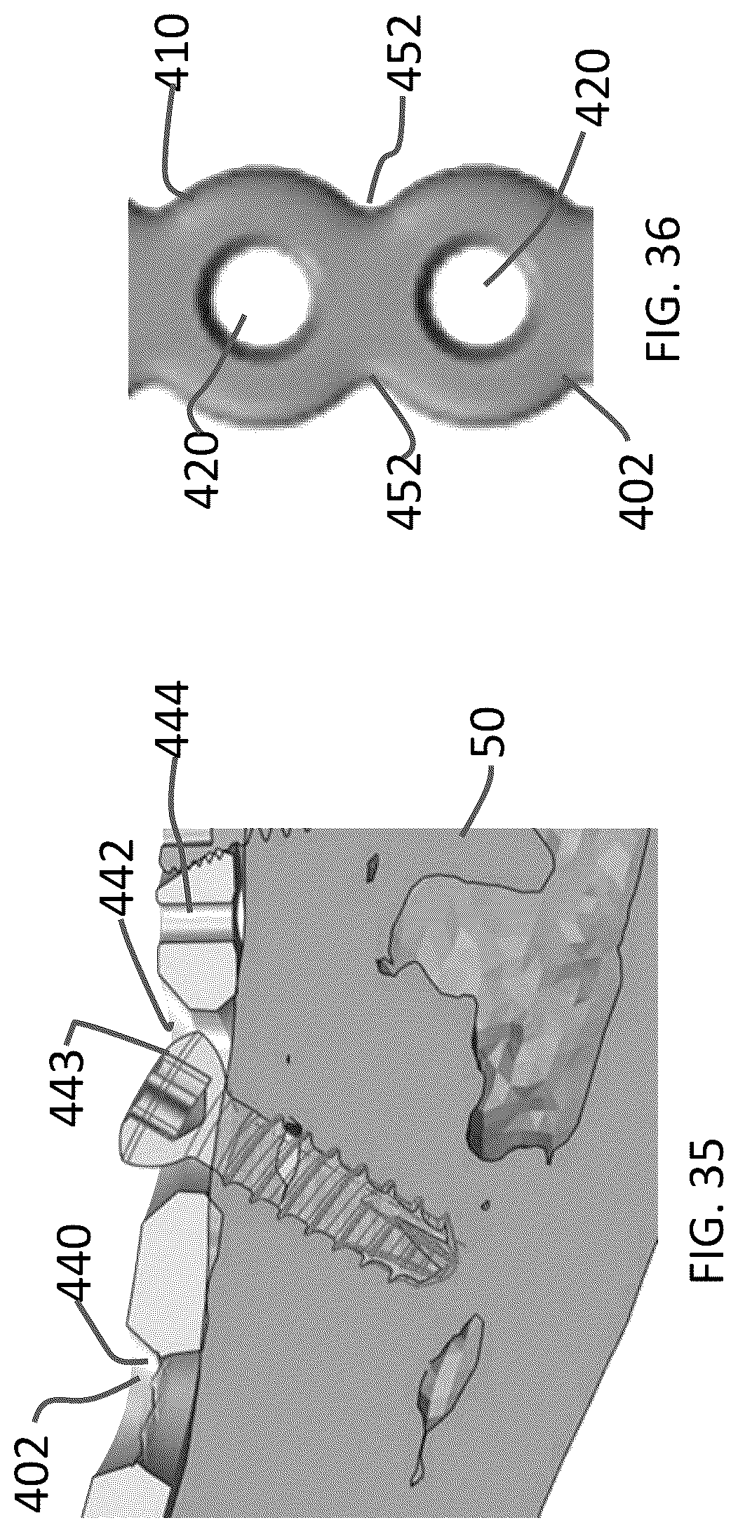 Patent US12102363 Figure 17 – Distal tibial plating system