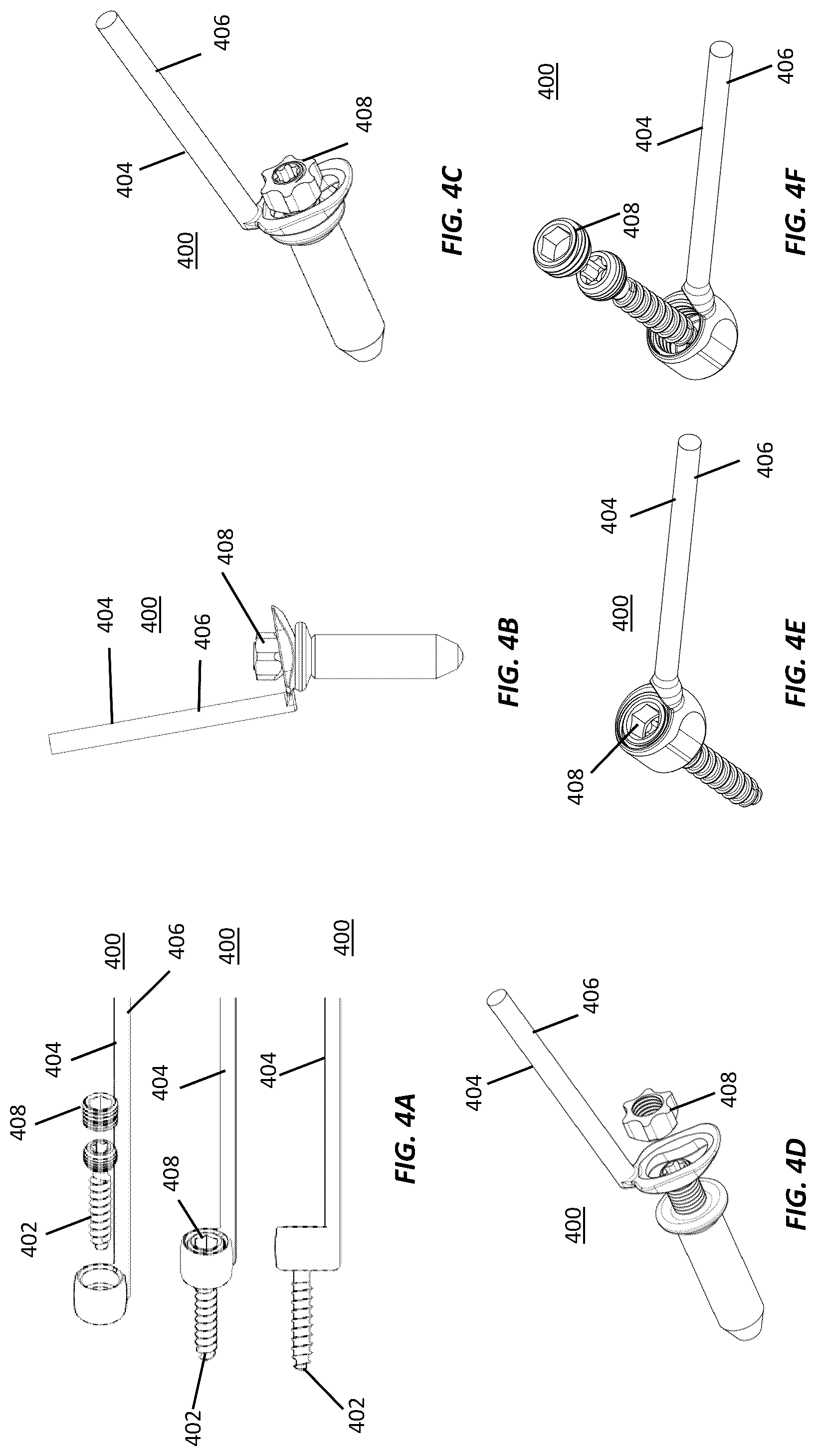 Patent US12102364 Figure 4 – Systems and methods for treating rib fractures and osteotomies using implantation
