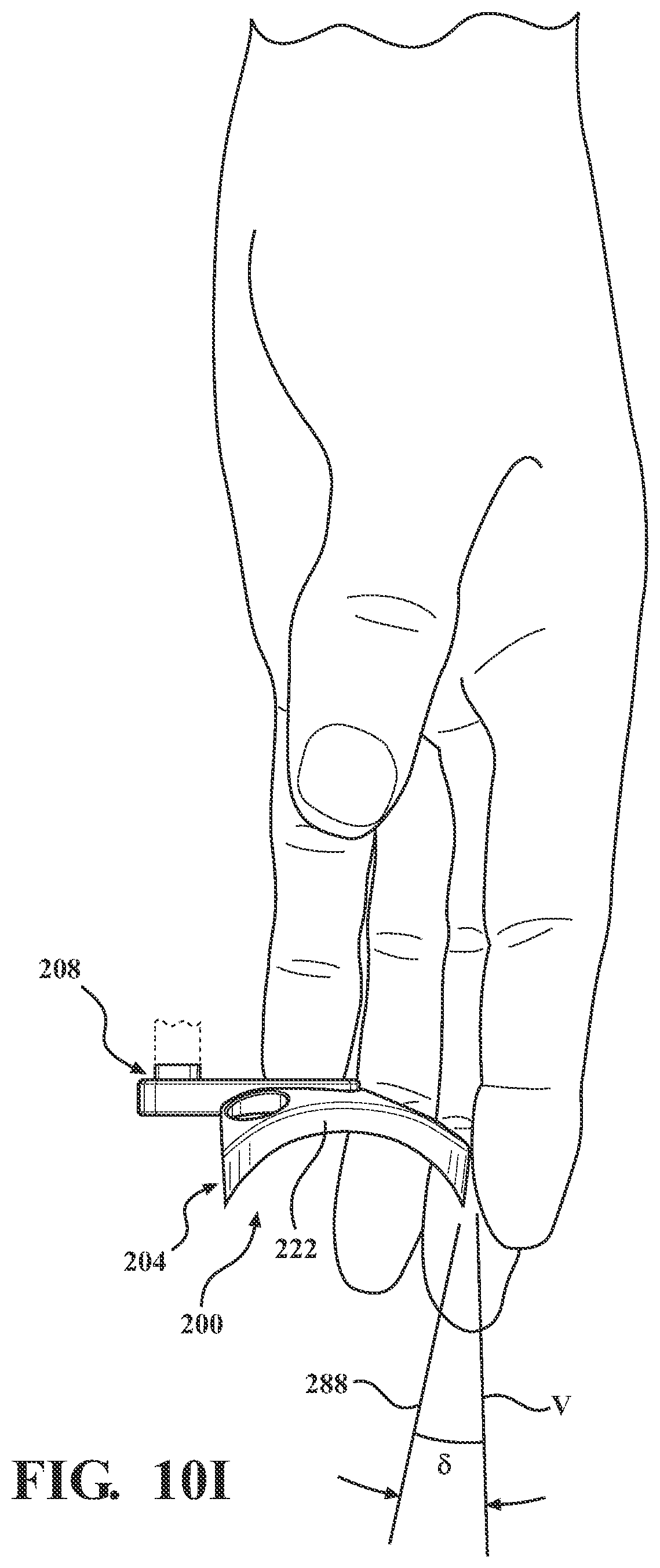 Patent US12102365 Figure 14 – Bone plate for attaching to an anatomic structure