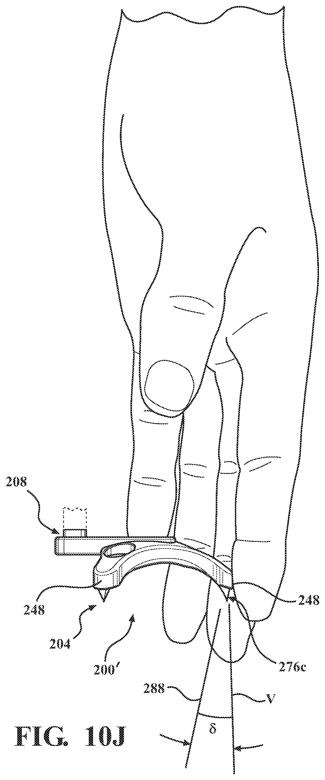 Patent US12102365 Figure 15 – Bone plate for attaching to an anatomic structure