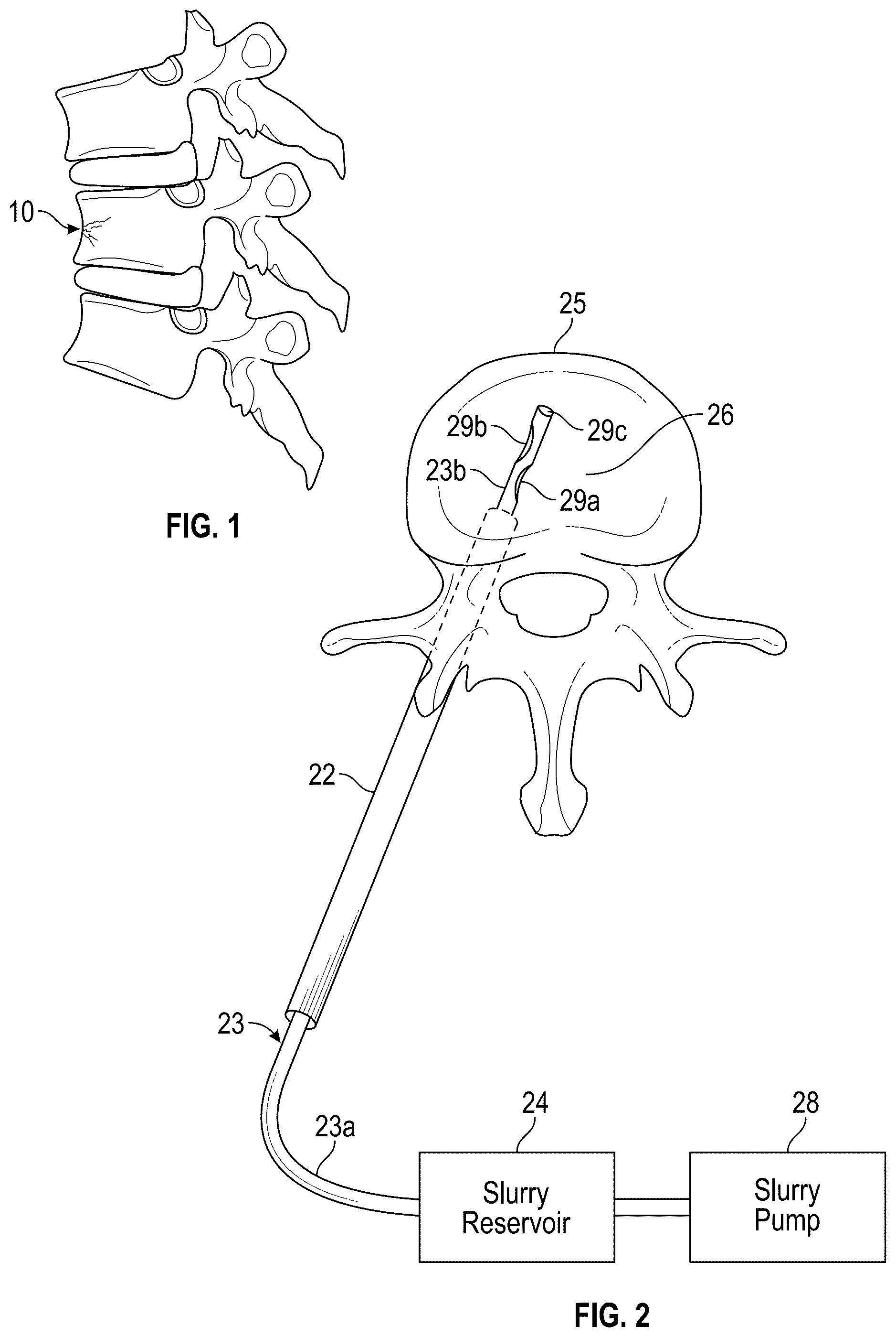 Patent US12102367 — Method, composition, and apparatus for stabilization of vertebral bodies — Figure 1