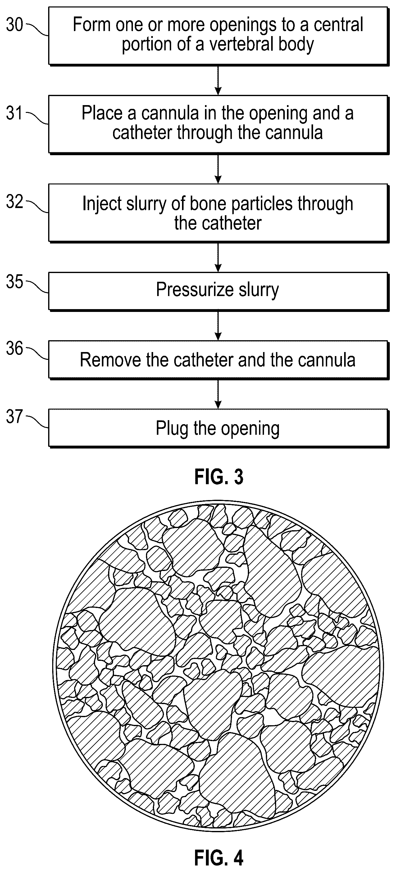 Patent US12102367 Figure 2 – Method, composition, and apparatus for stabilization of vertebral bodies