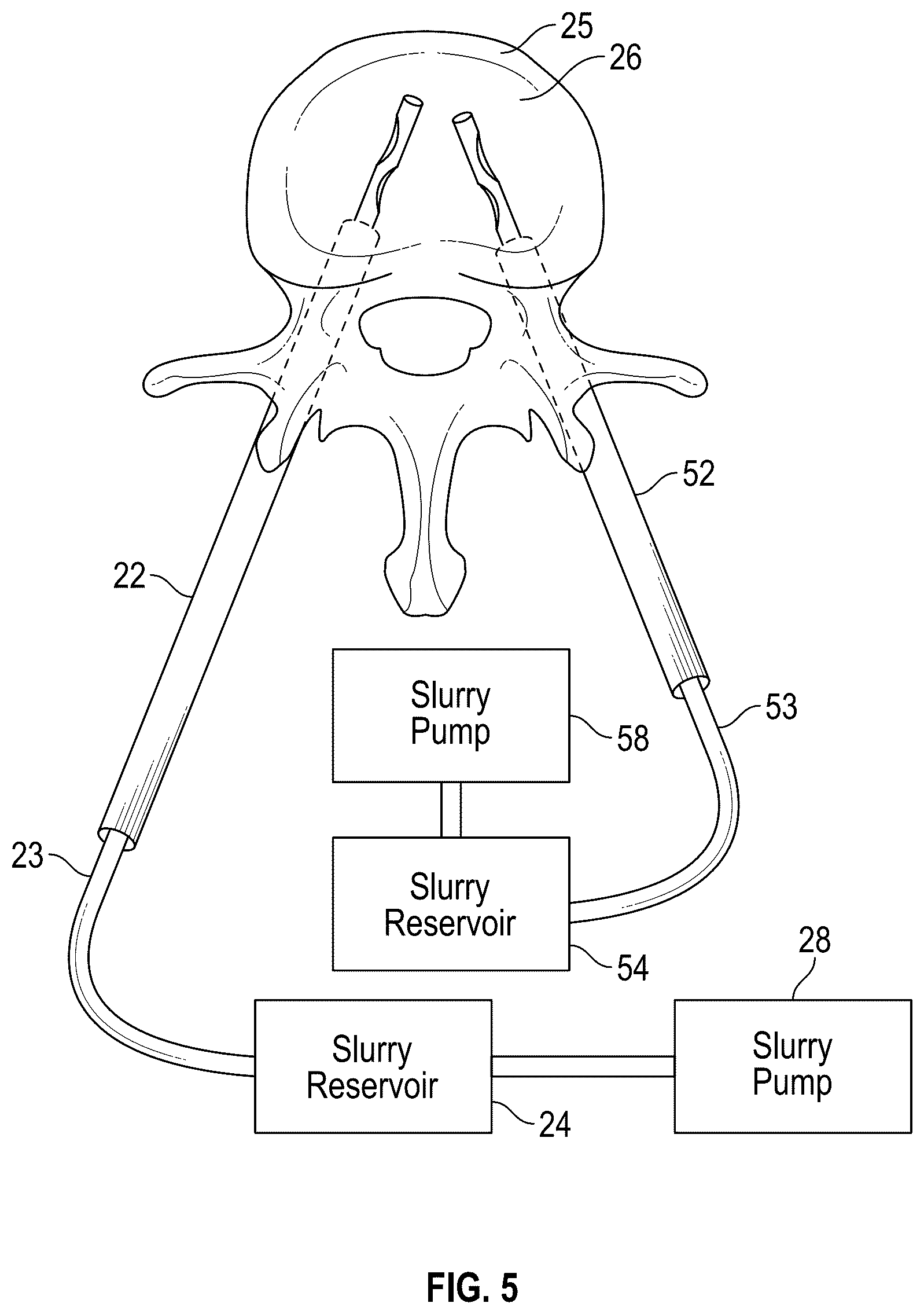 Patent US12102367 Figure 3 – Method, composition, and apparatus for stabilization of vertebral bodies