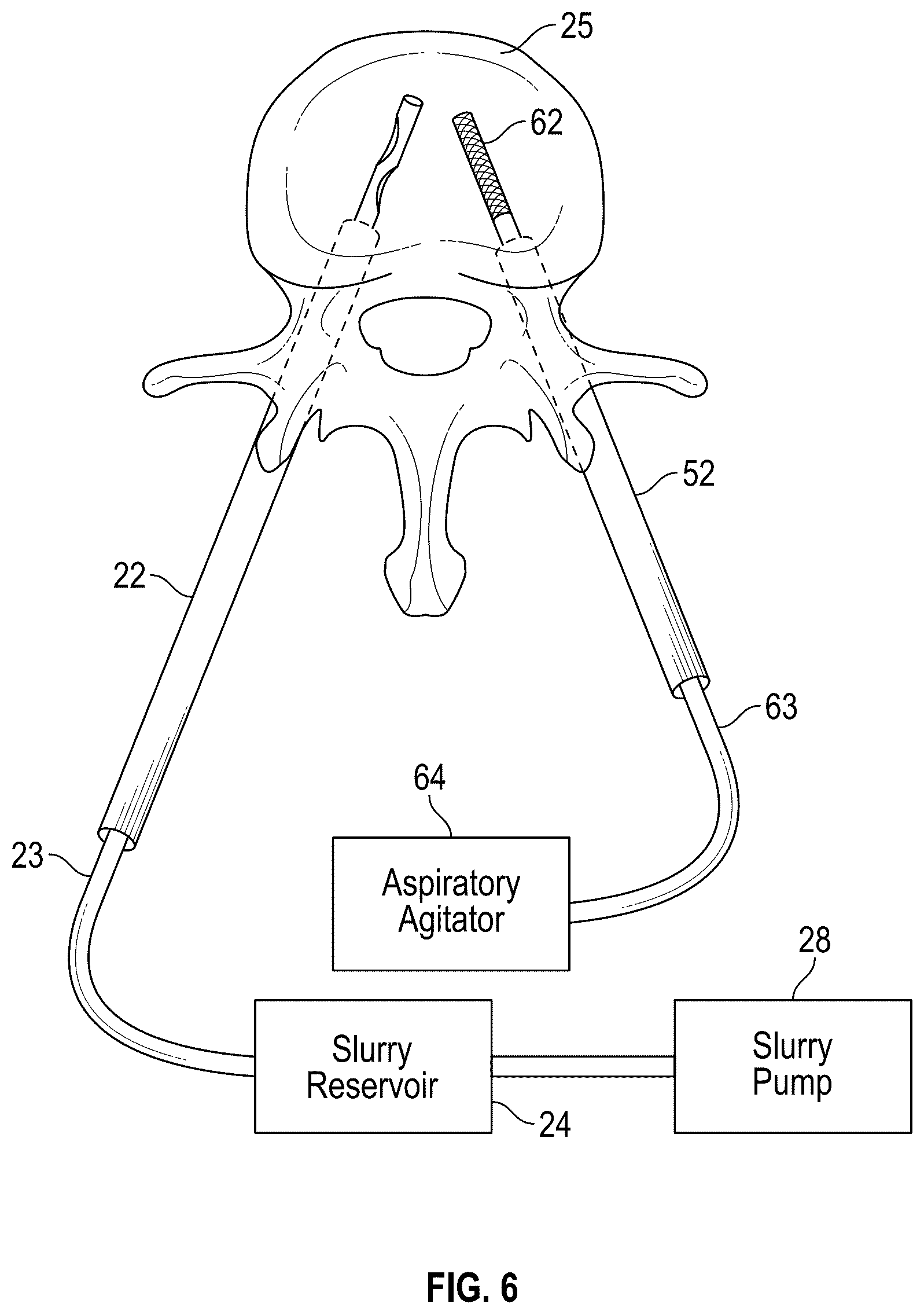 Patent US12102367 Figure 4 – Method, composition, and apparatus for stabilization of vertebral bodies