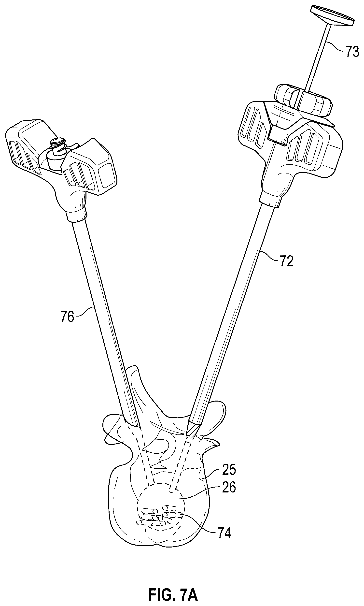 Patent US12102367 Figure 5 – Method, composition, and apparatus for stabilization of vertebral bodies
