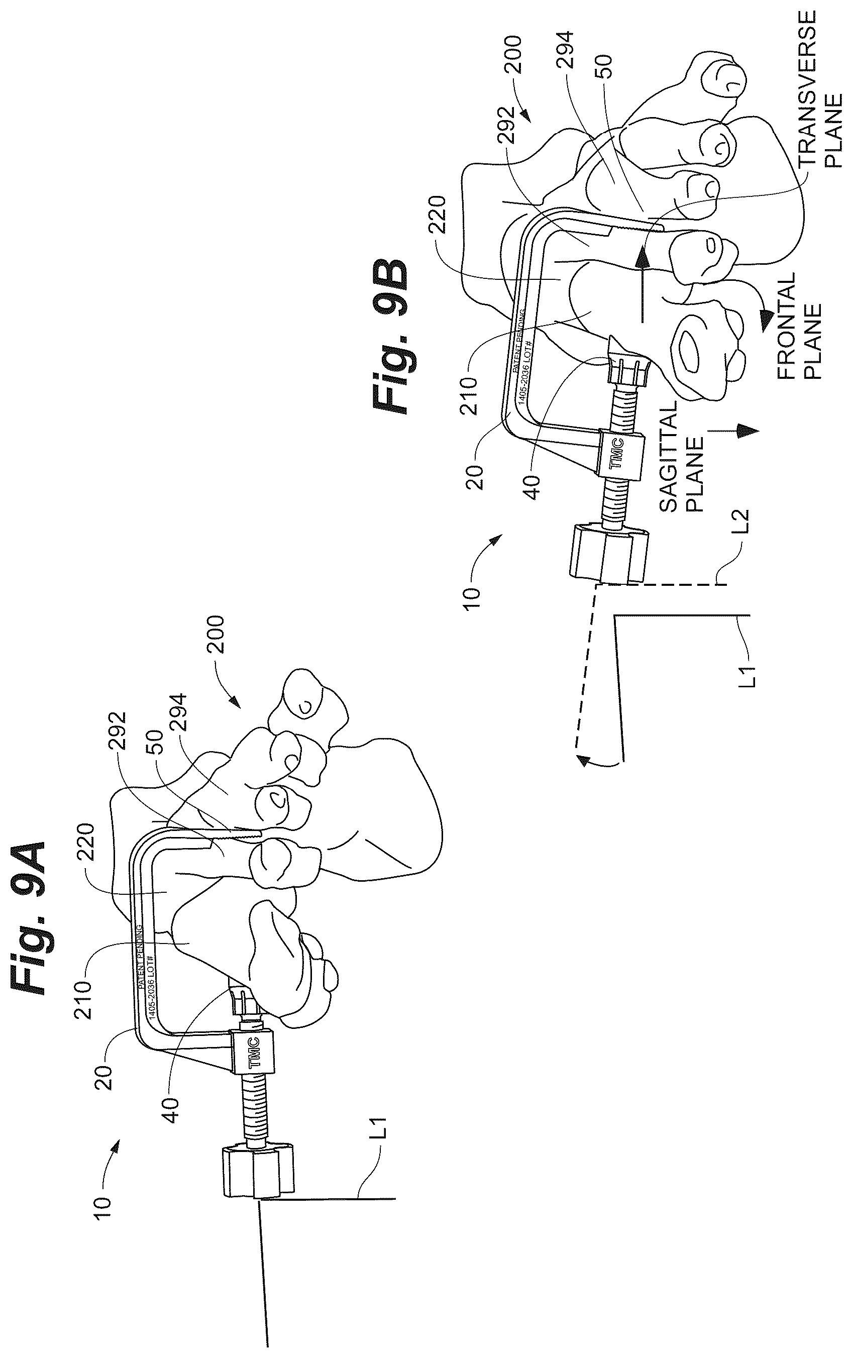 Patent US12102368 Figure 11 – Bone positioning guide