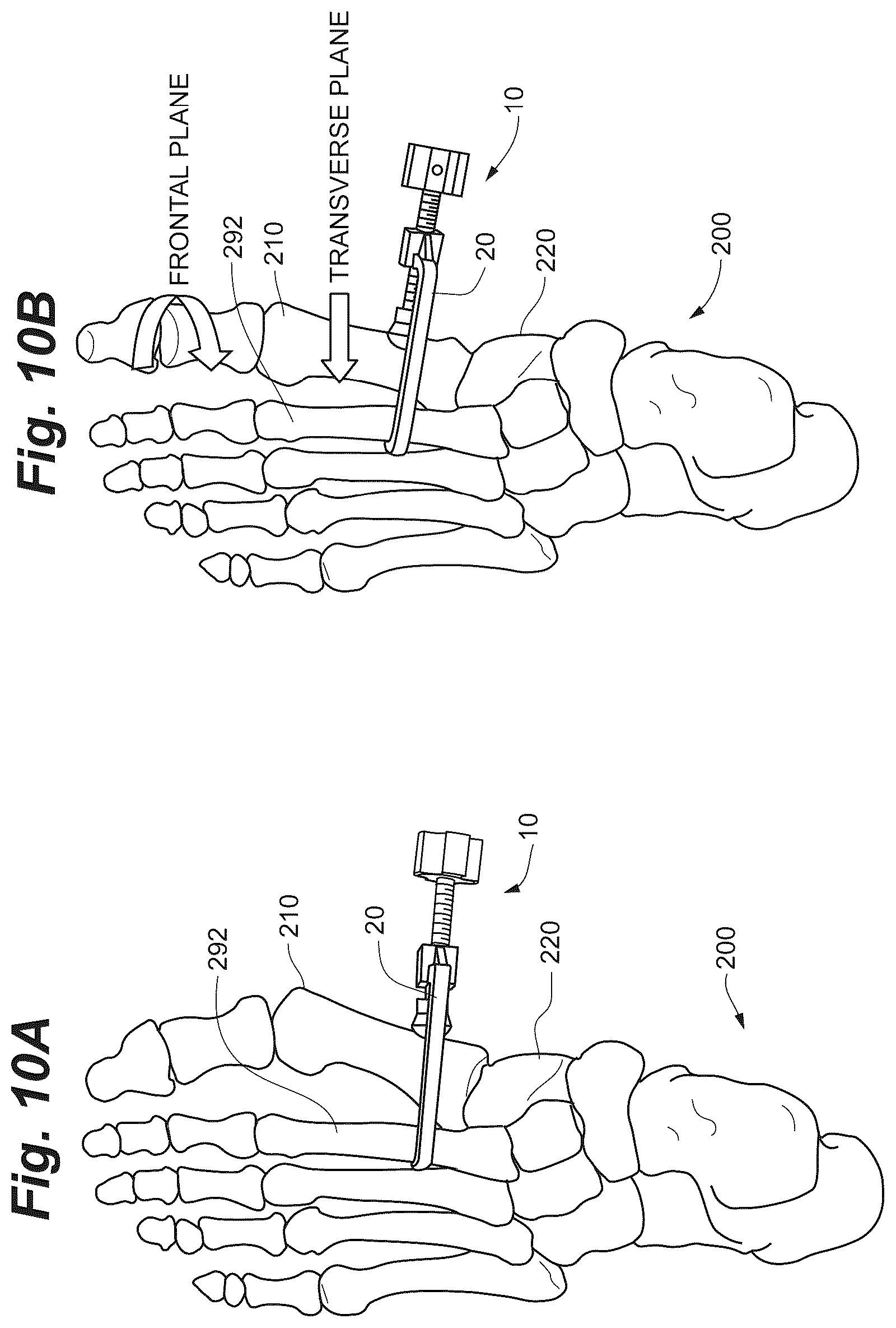 Patent US12102368 Figure 12 – Bone positioning guide