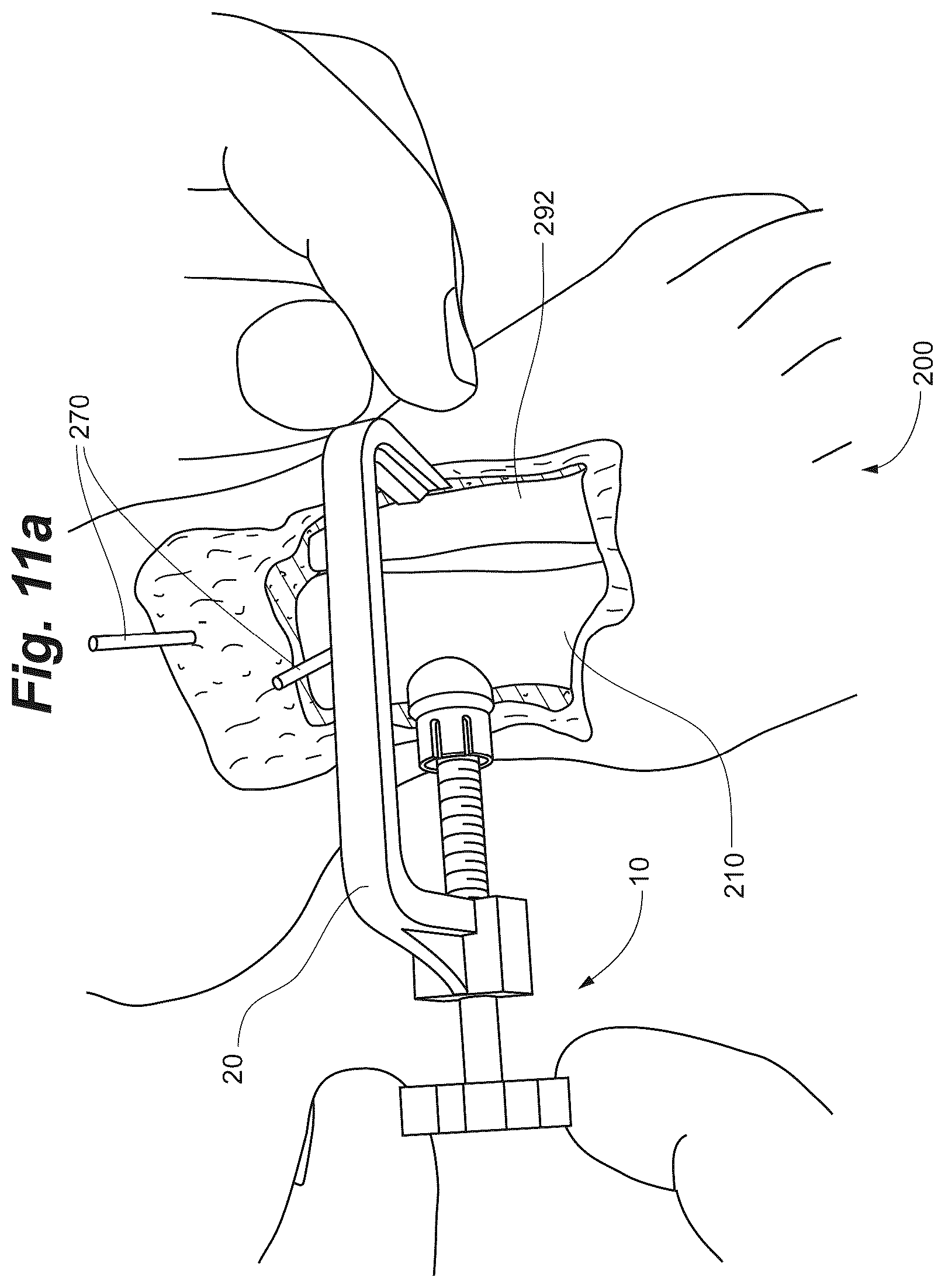 Patent US12102368 Figure 13 – Bone positioning guide