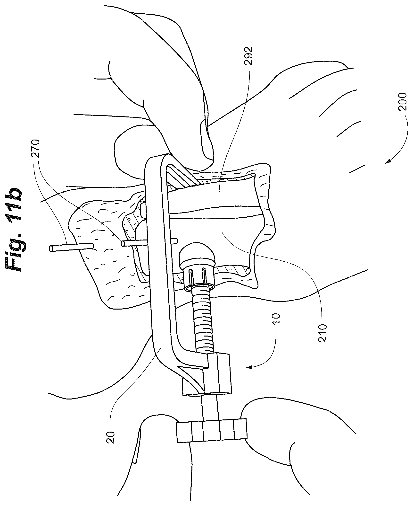 Patent US12102368 Figure 14 – Bone positioning guide