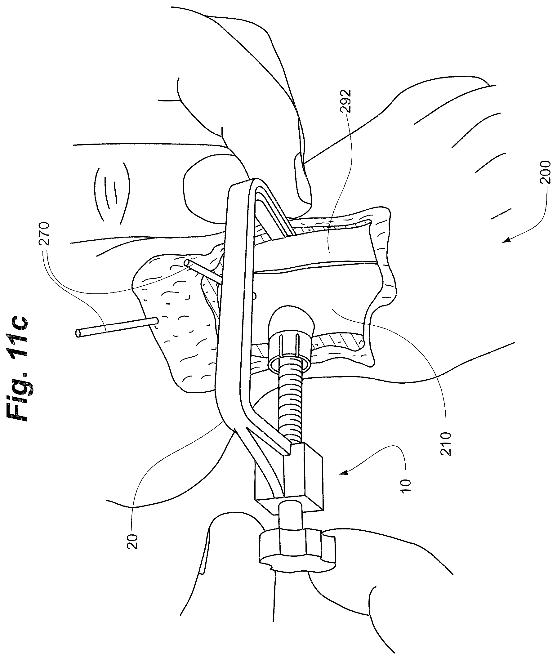 Patent US12102368 Figure 15 – Bone positioning guide