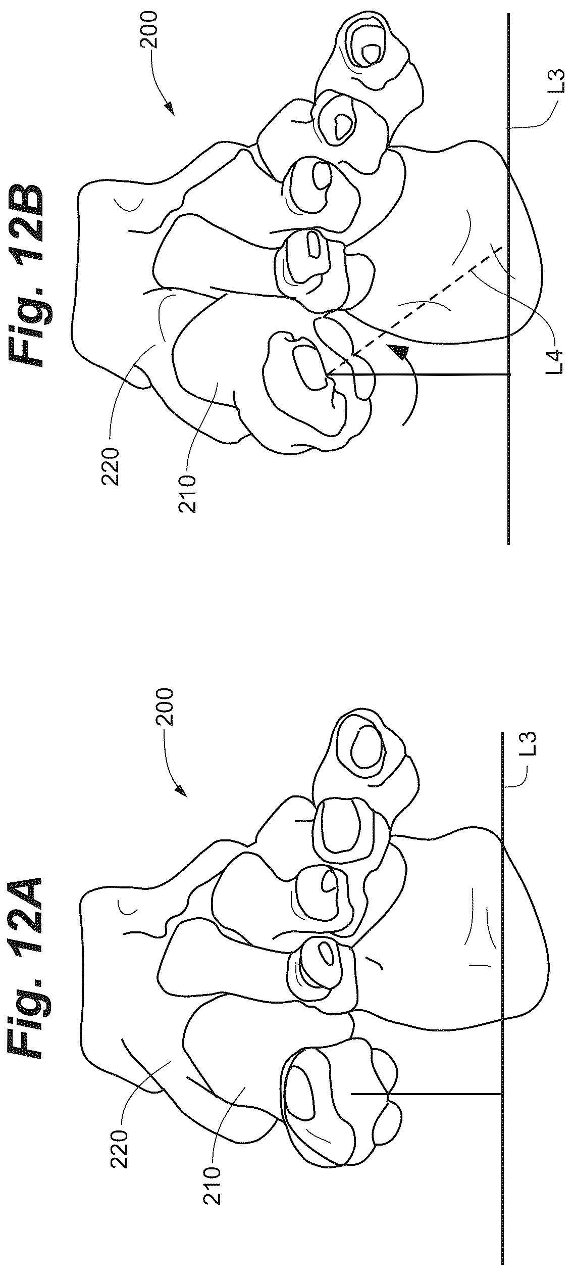 Patent US12102368 Figure 16 – Bone positioning guide