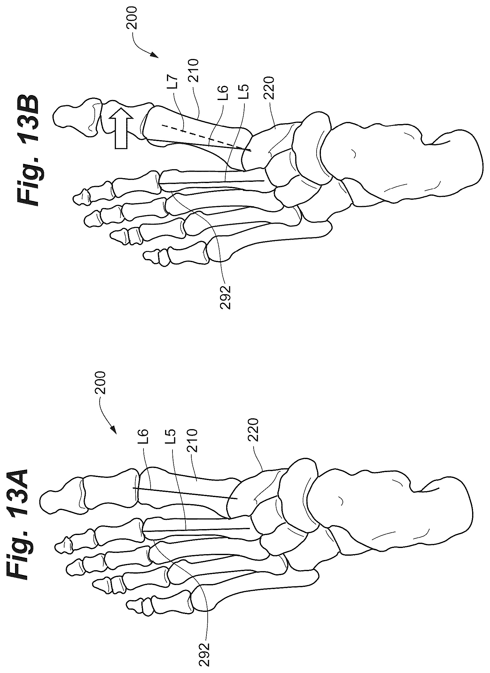 Patent US12102368 Figure 17 – Bone positioning guide