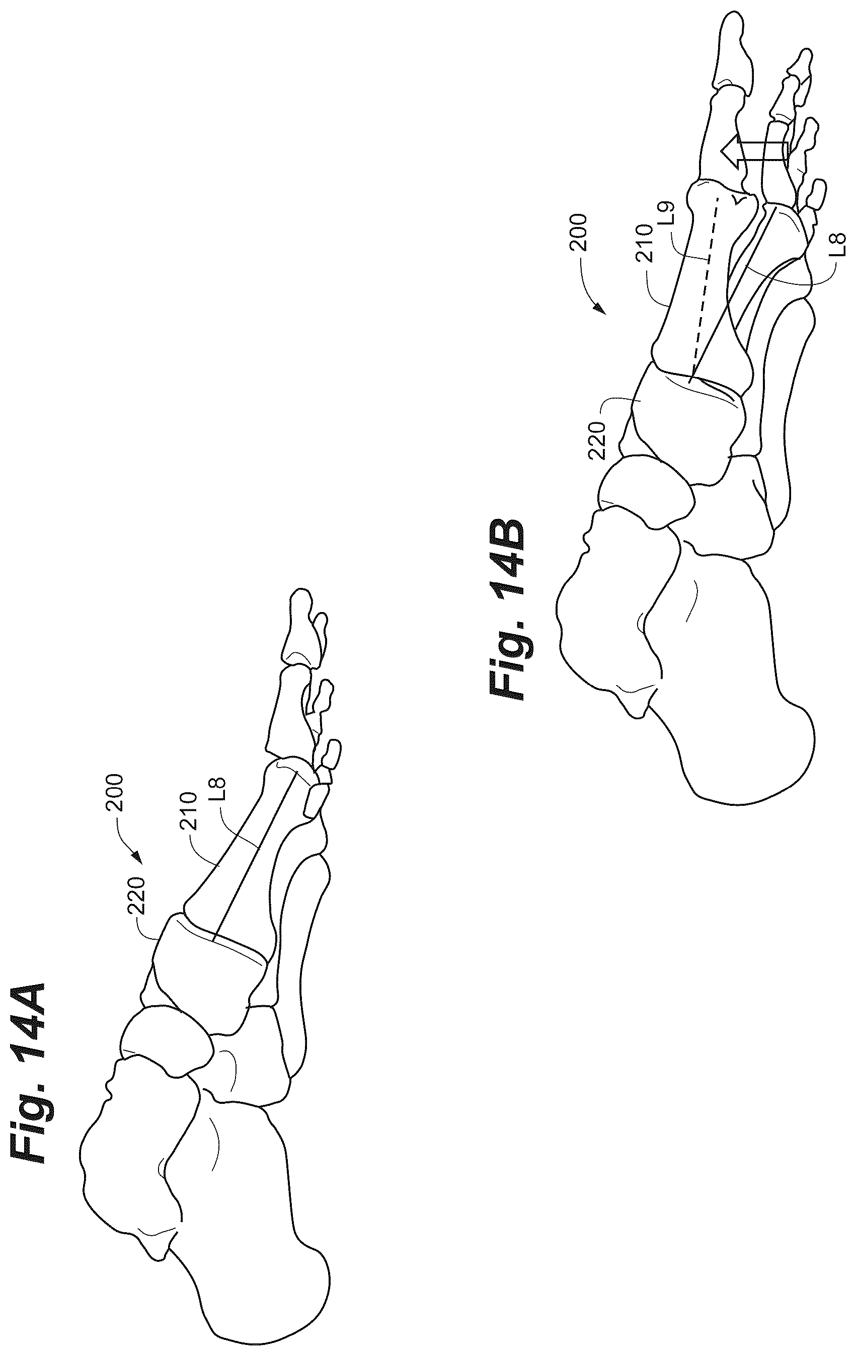 Patent US12102368 Figure 18 – Bone positioning guide