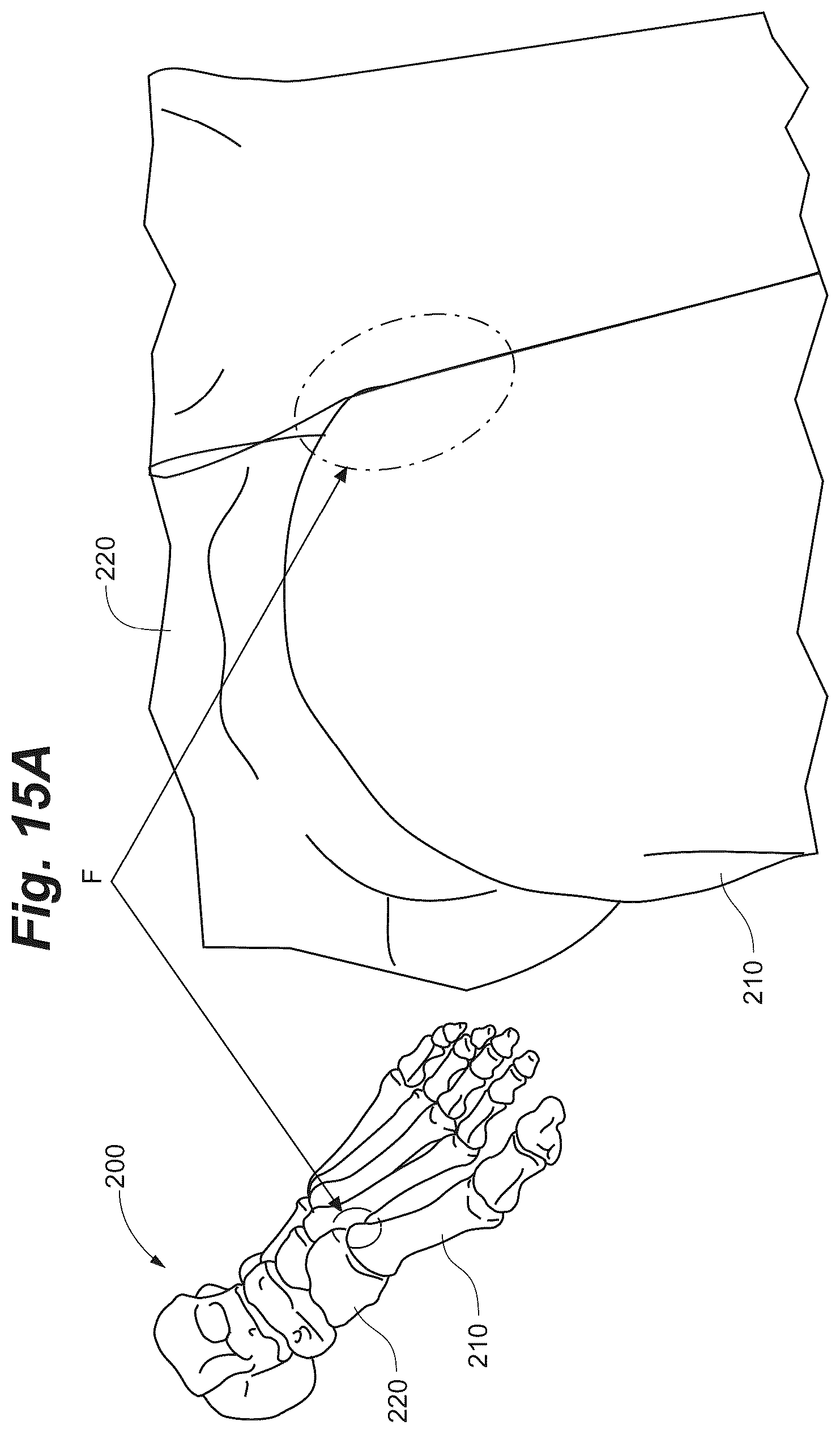 Patent US12102368 Figure 19 – Bone positioning guide
