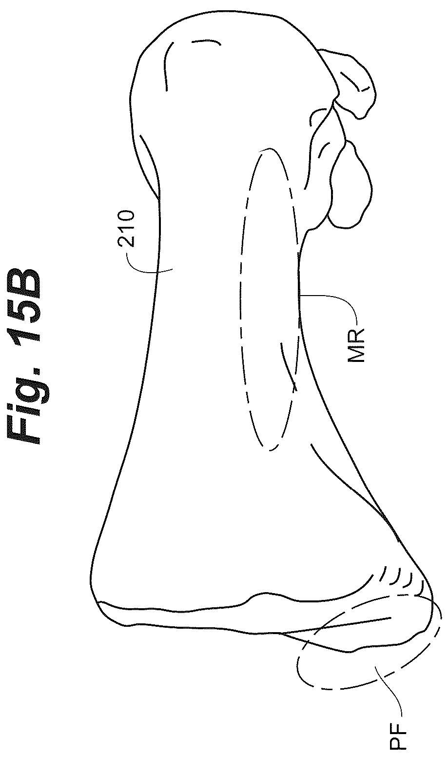 Patent US12102368 Figure 20 – Bone positioning guide