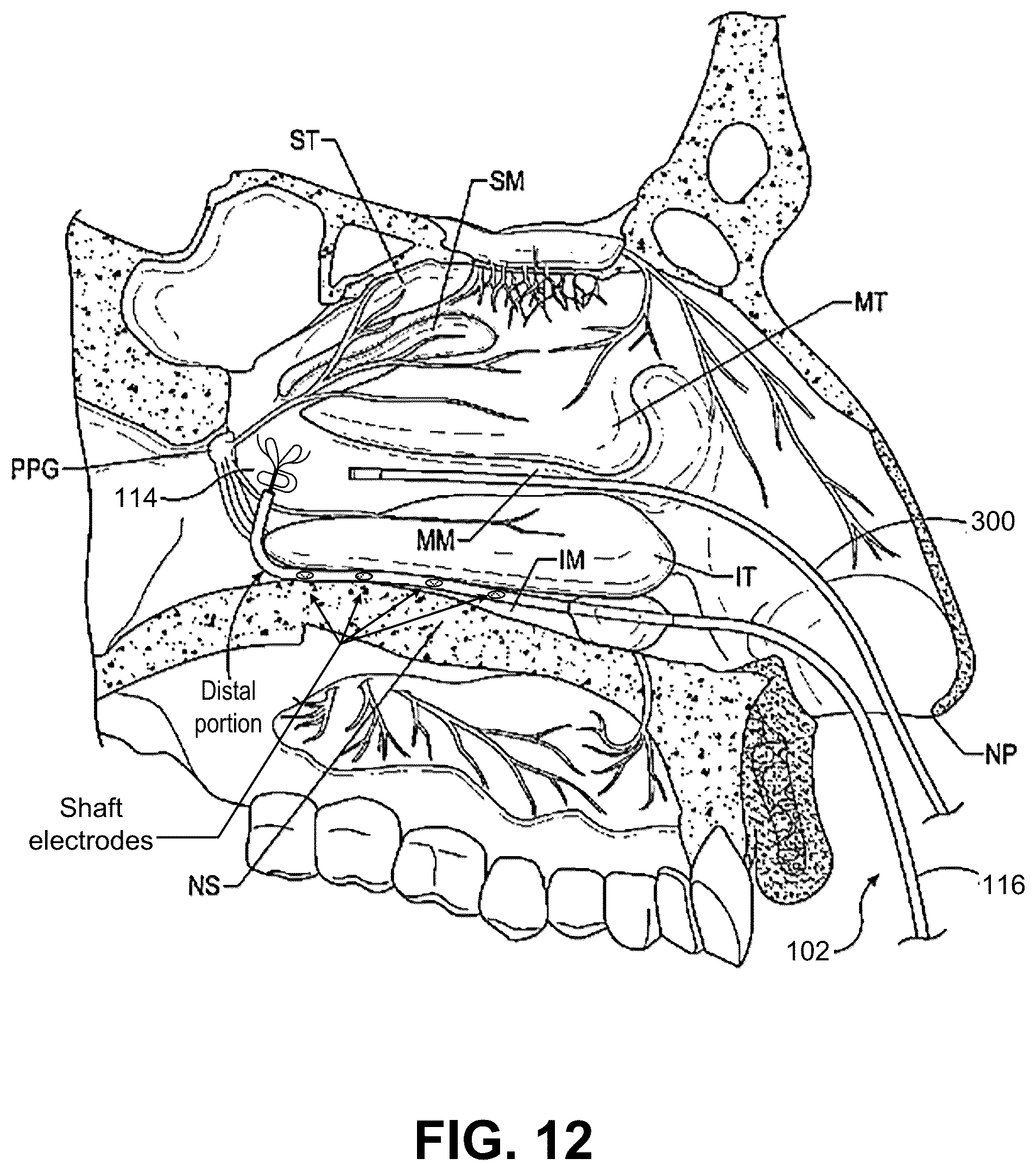 Patent US12102379 Figure 18 – Systems and methods for therapeutic nasal treatment using handheld device