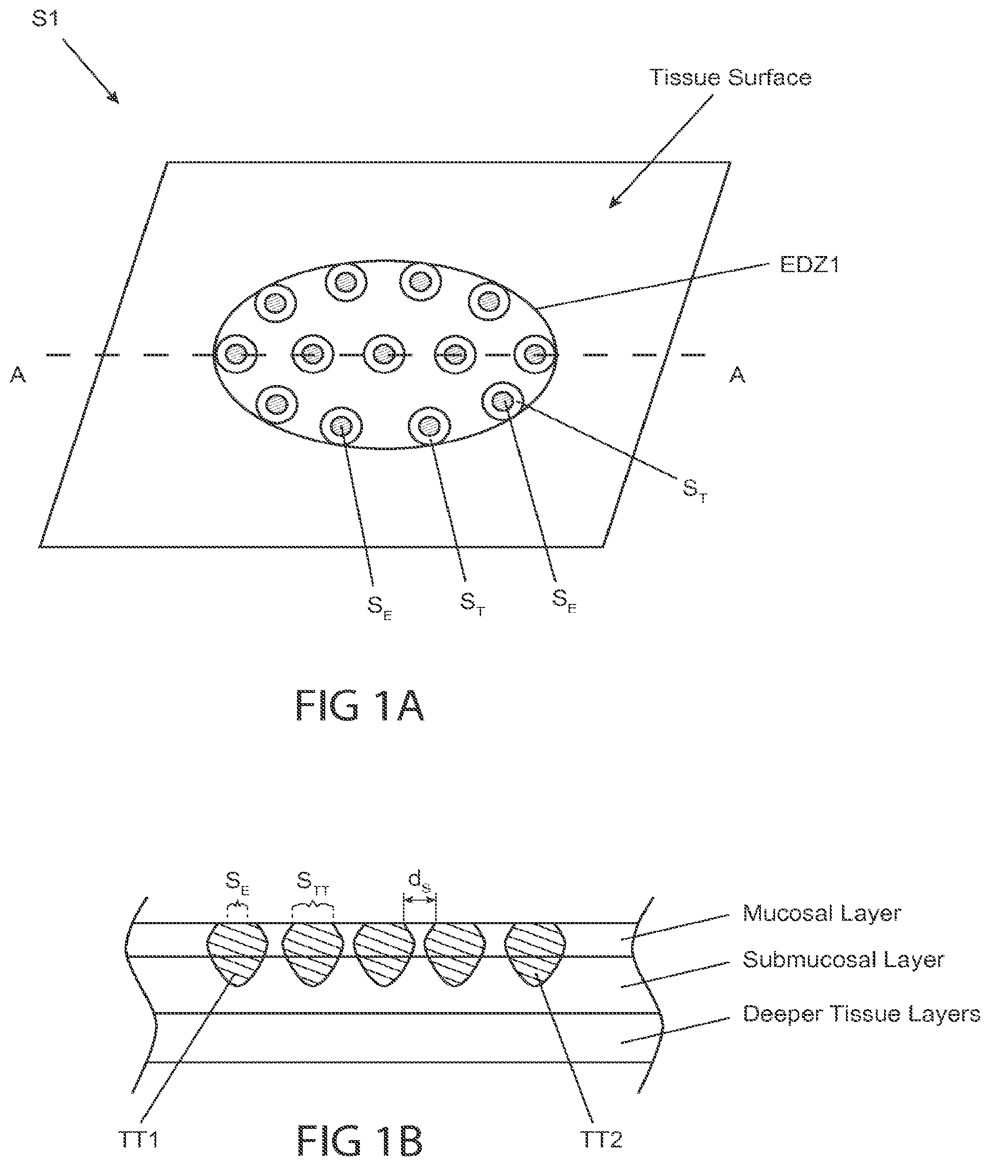 Patent US12102380 Figure 2 – Methods, systems and devices for reducing the luminal surface area of the gastrointestinal tract
