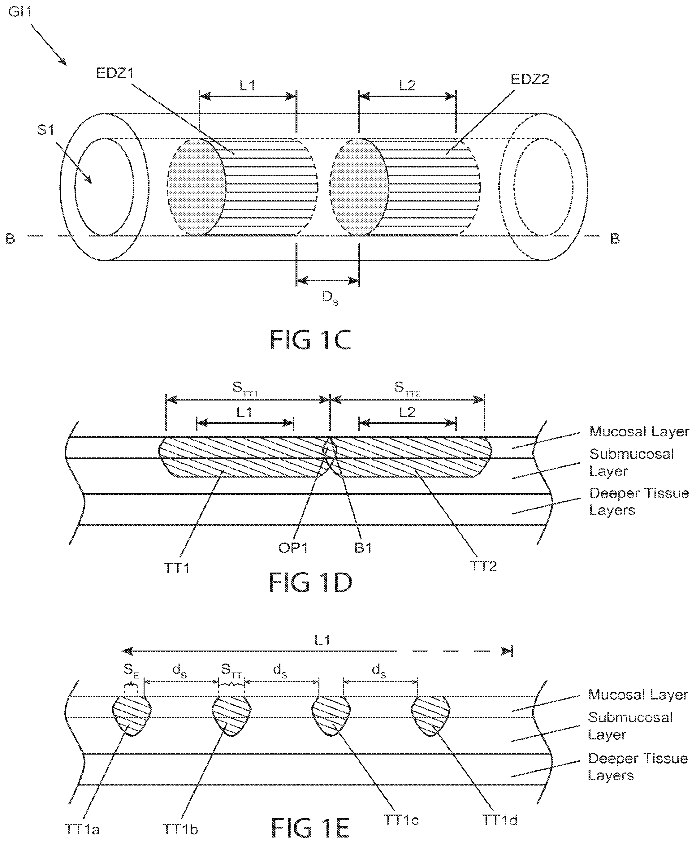Patent US12102380 Figure 3 – Methods, systems and devices for reducing the luminal surface area of the gastrointestinal tract
