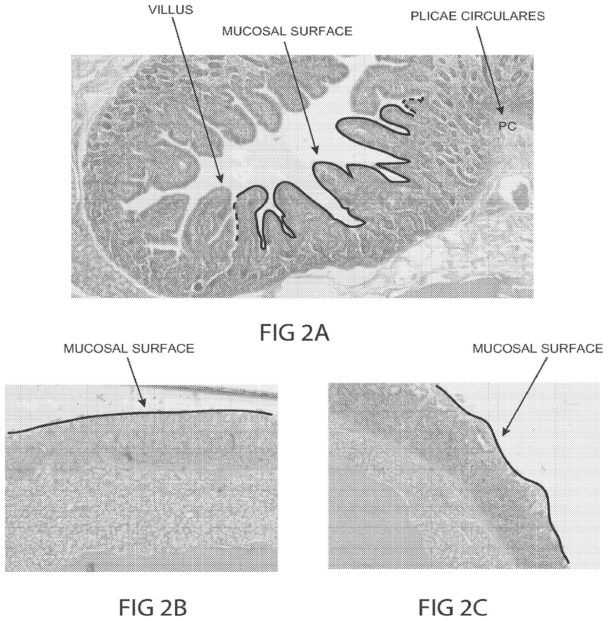 Patent US12102380 Figure 4 – Methods, systems and devices for reducing the luminal surface area of the gastrointestinal tract