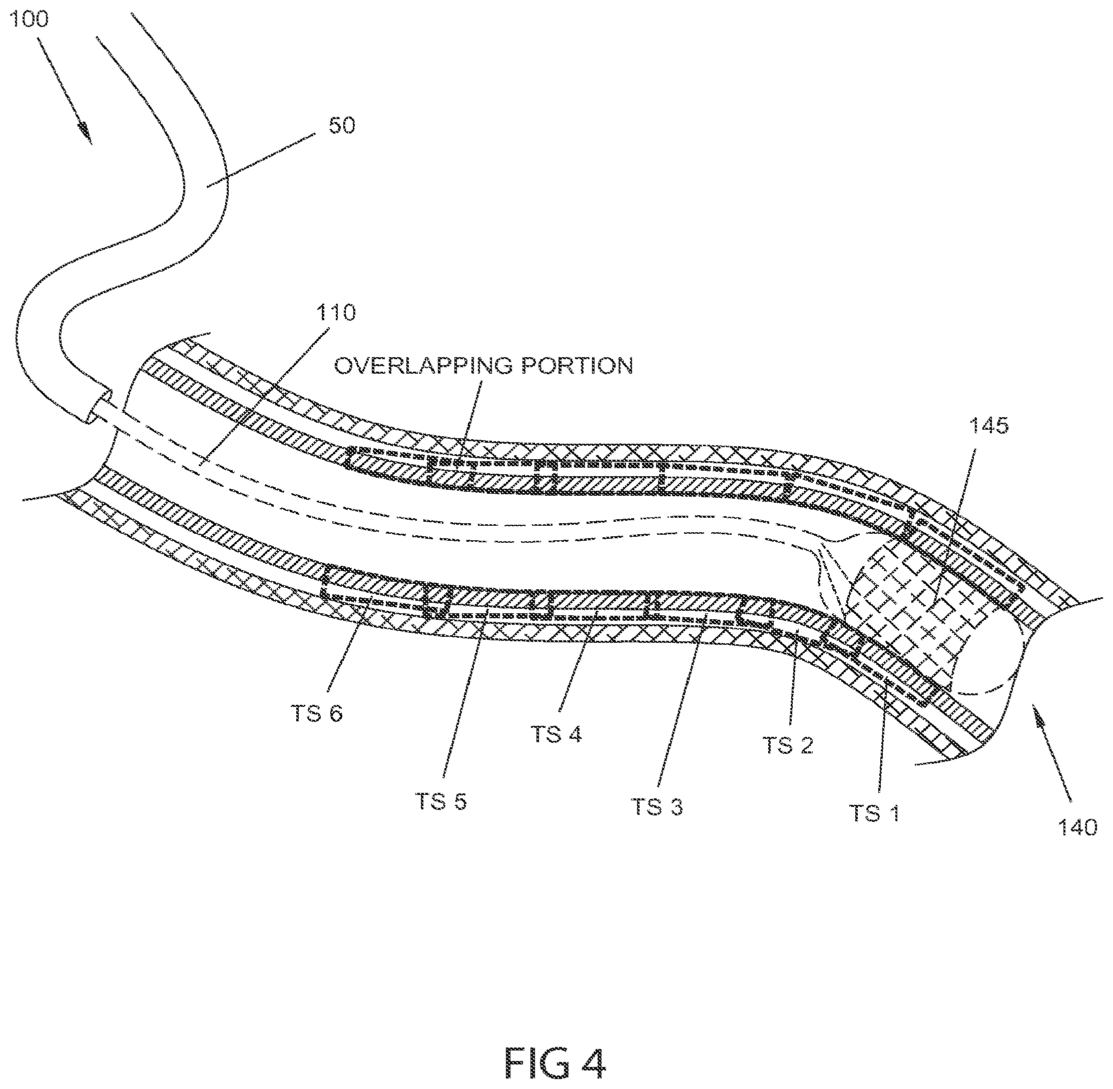 Patent US12102380 Figure 6 – Methods, systems and devices for reducing the luminal surface area of the gastrointestinal tract