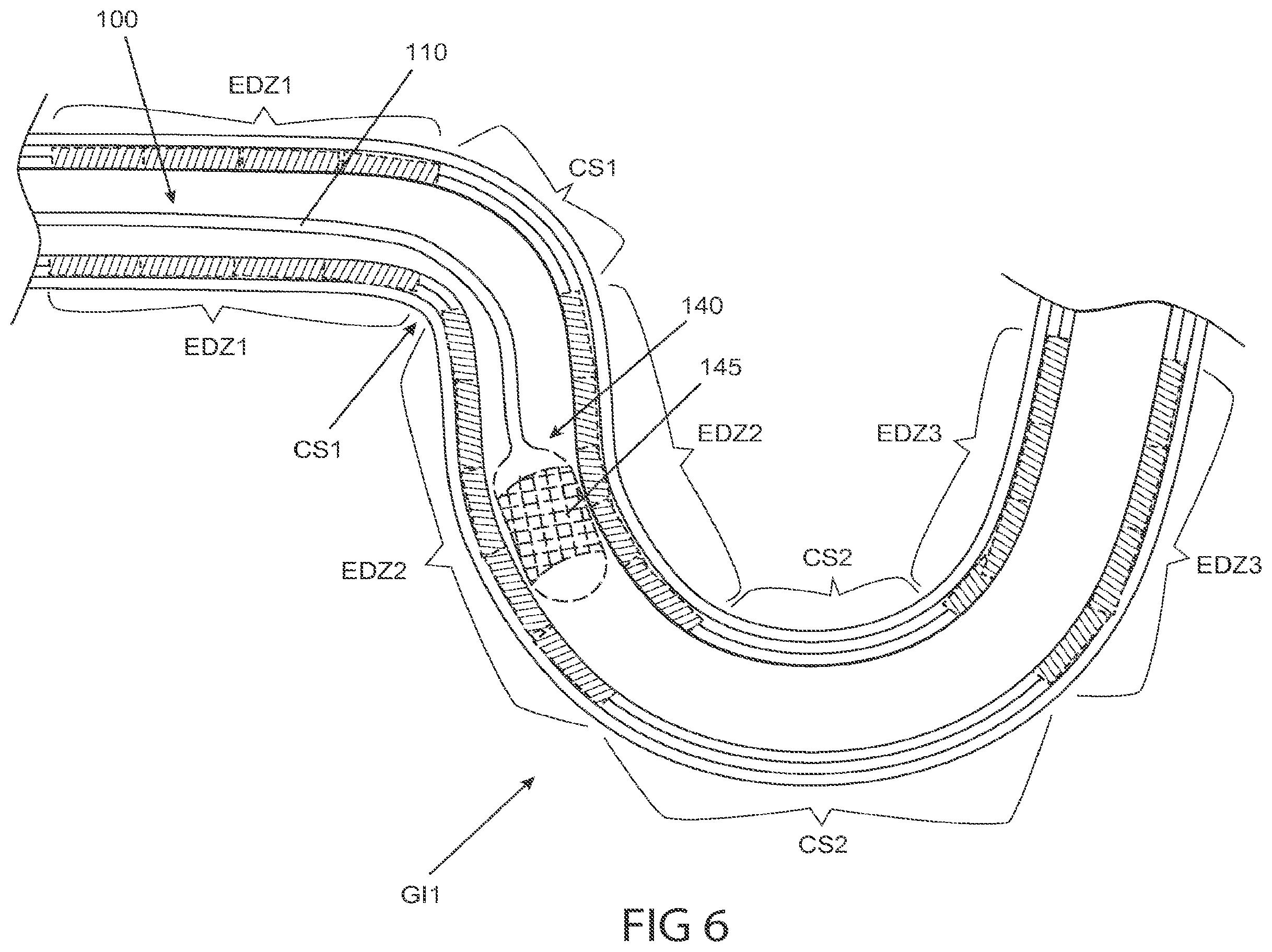 Patent US12102380 Figure 8 – Methods, systems and devices for reducing the luminal surface area of the gastrointestinal tract