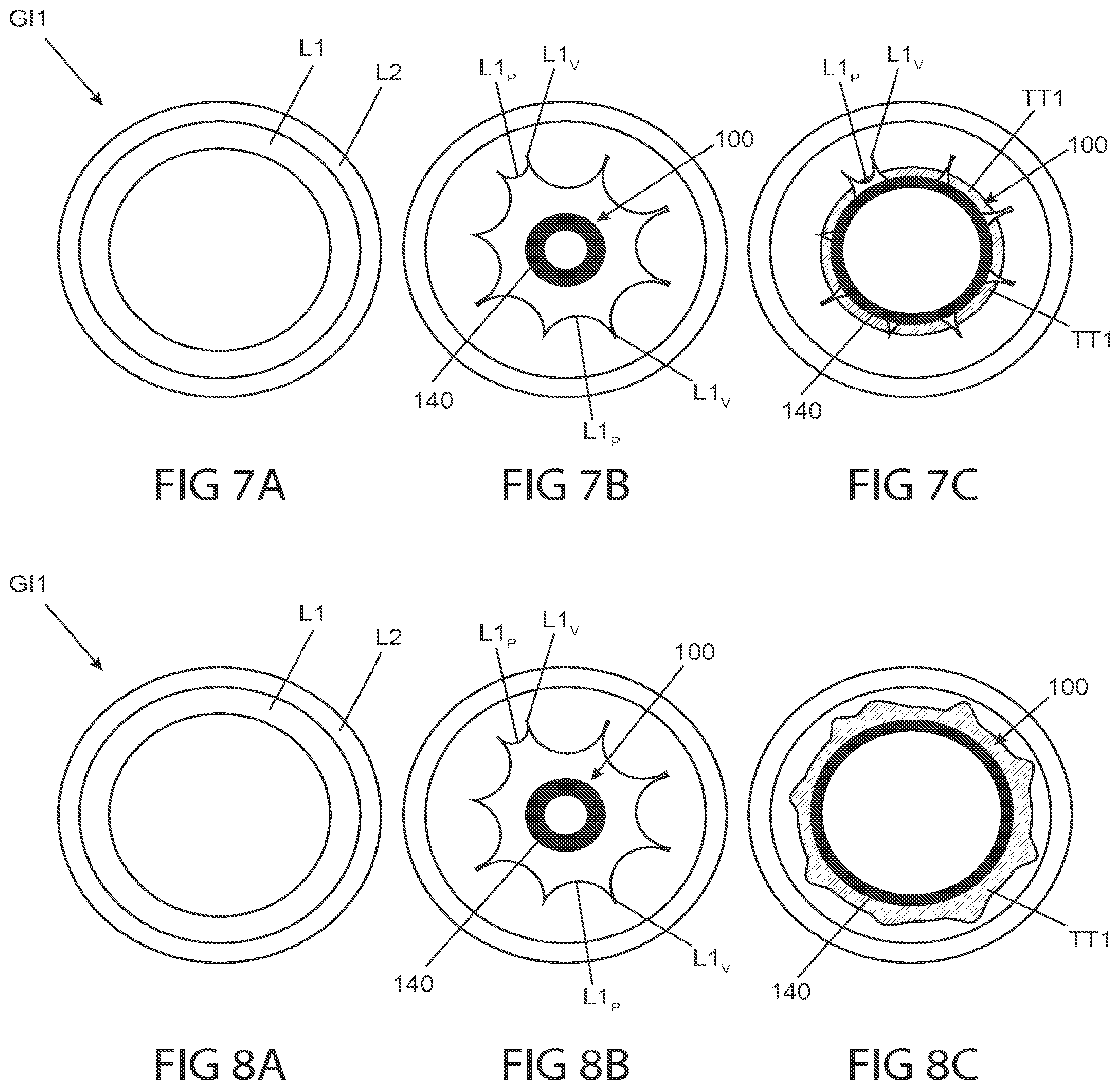 Patent US12102380 Figure 9 – Methods, systems and devices for reducing the luminal surface area of the gastrointestinal tract