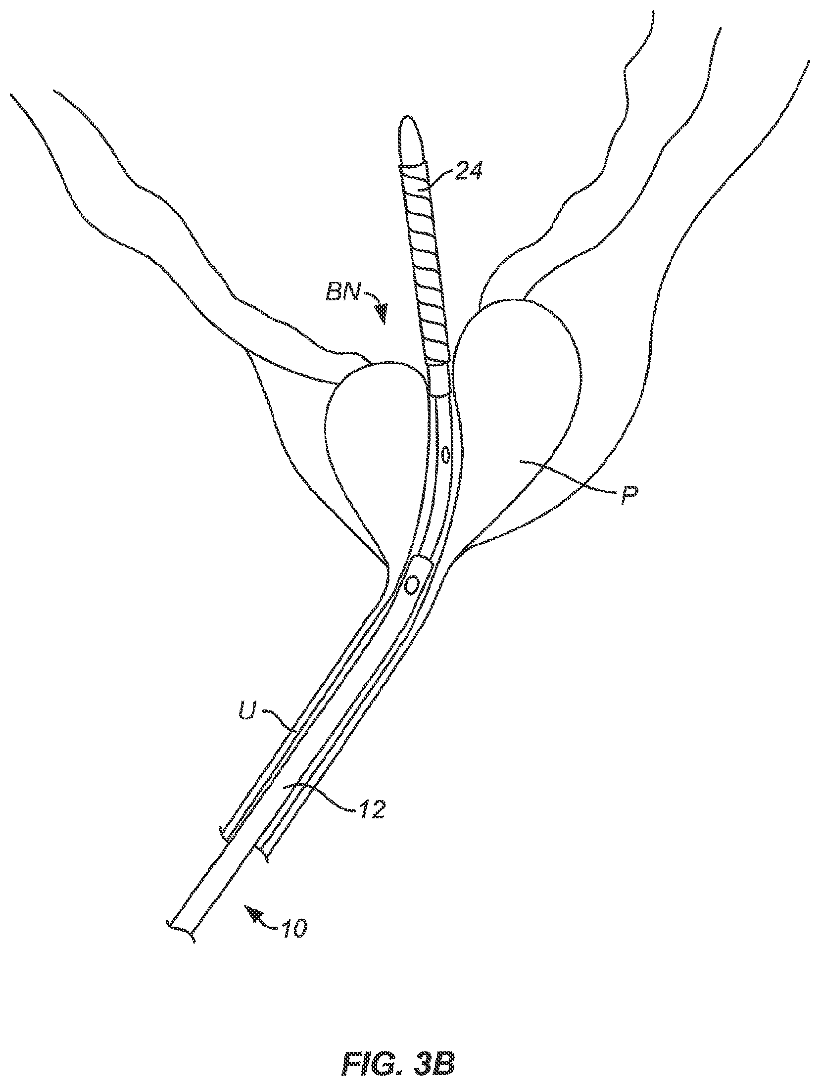 Patent US12102383 Figure 4 – Tissue resection device with motors and control circuitry