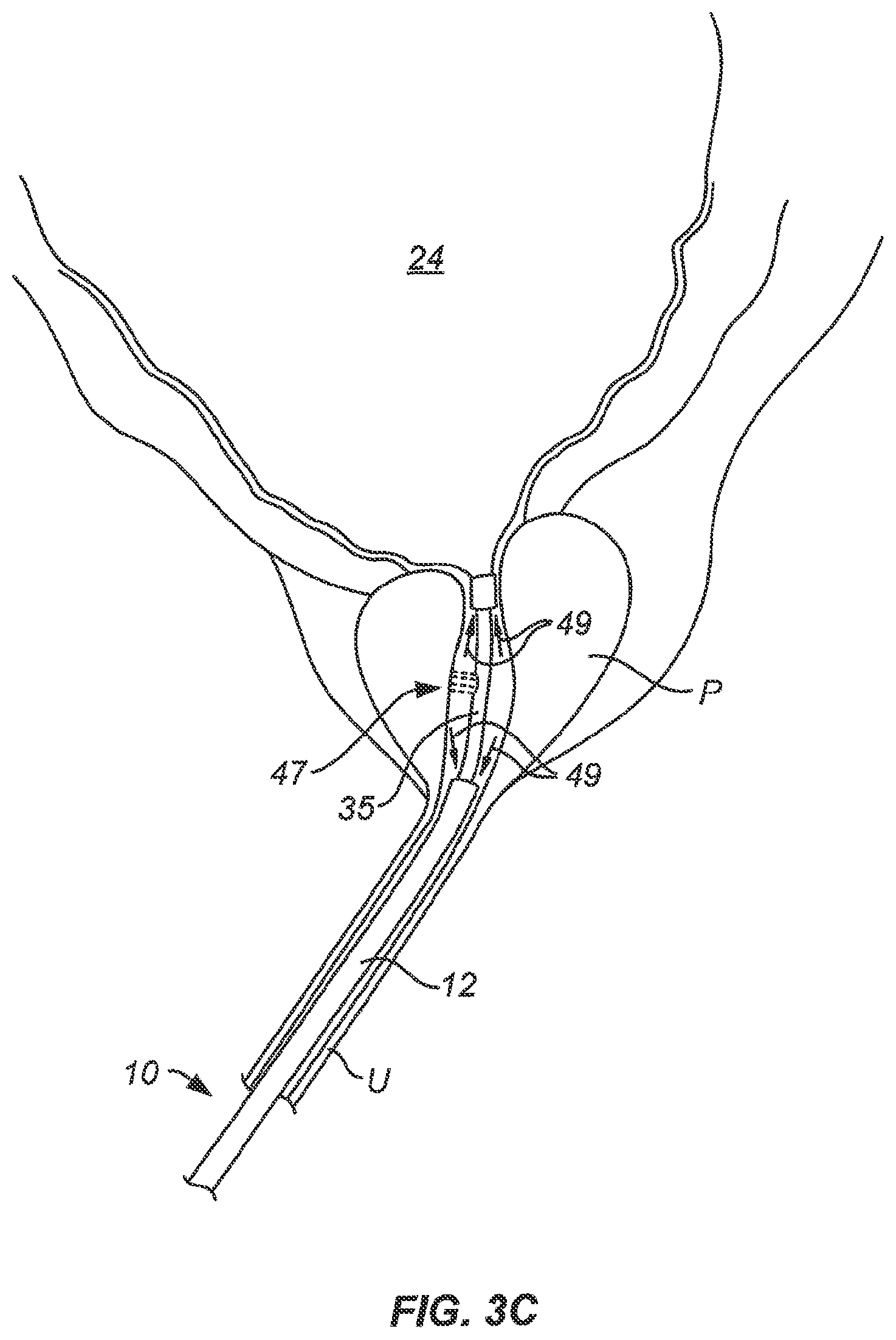 Patent US12102383 Figure 5 – Tissue resection device with motors and control circuitry