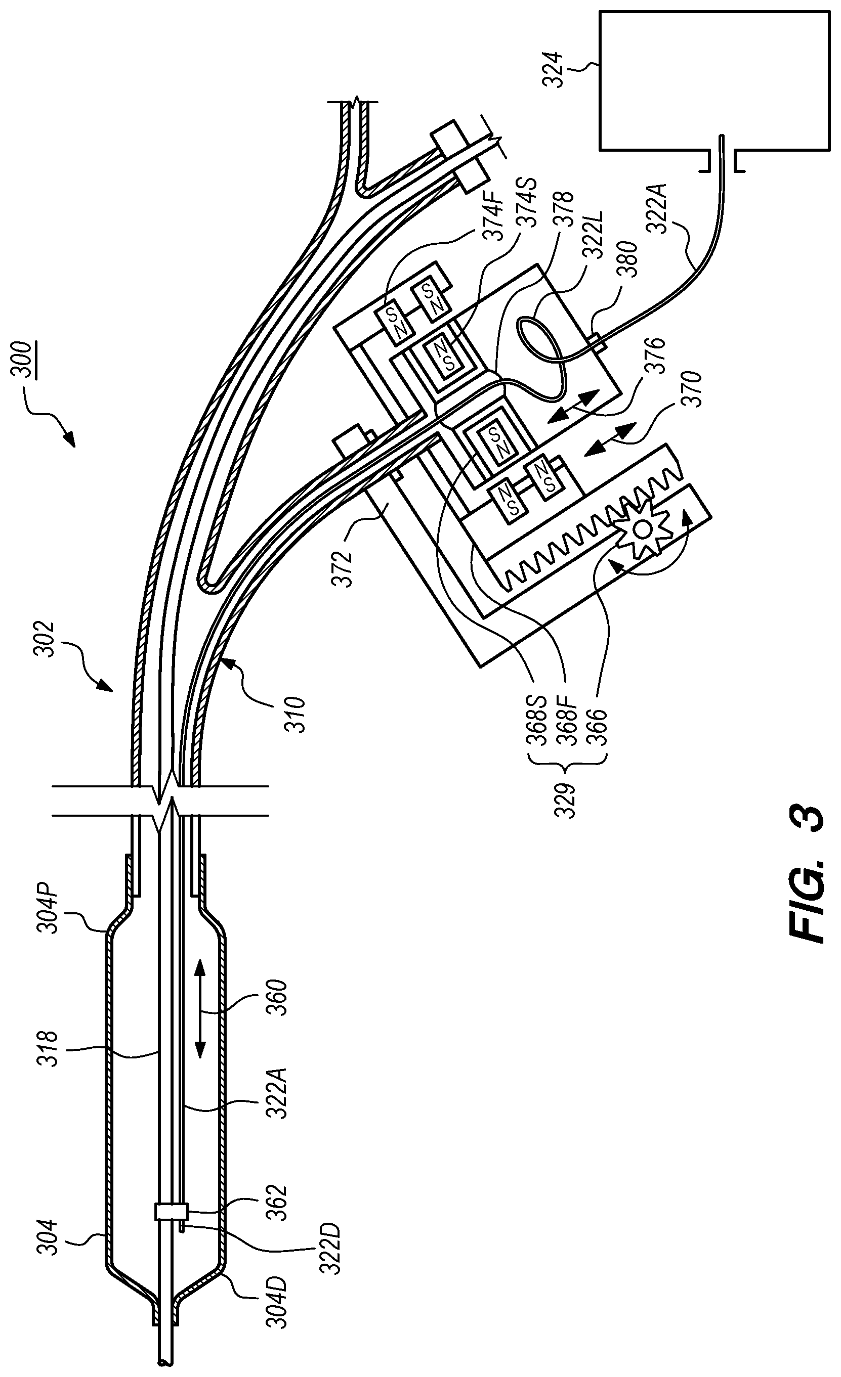 Patent US12102384 Figure 3 – Dynamic intravascular lithotripsy device with movable energy guide