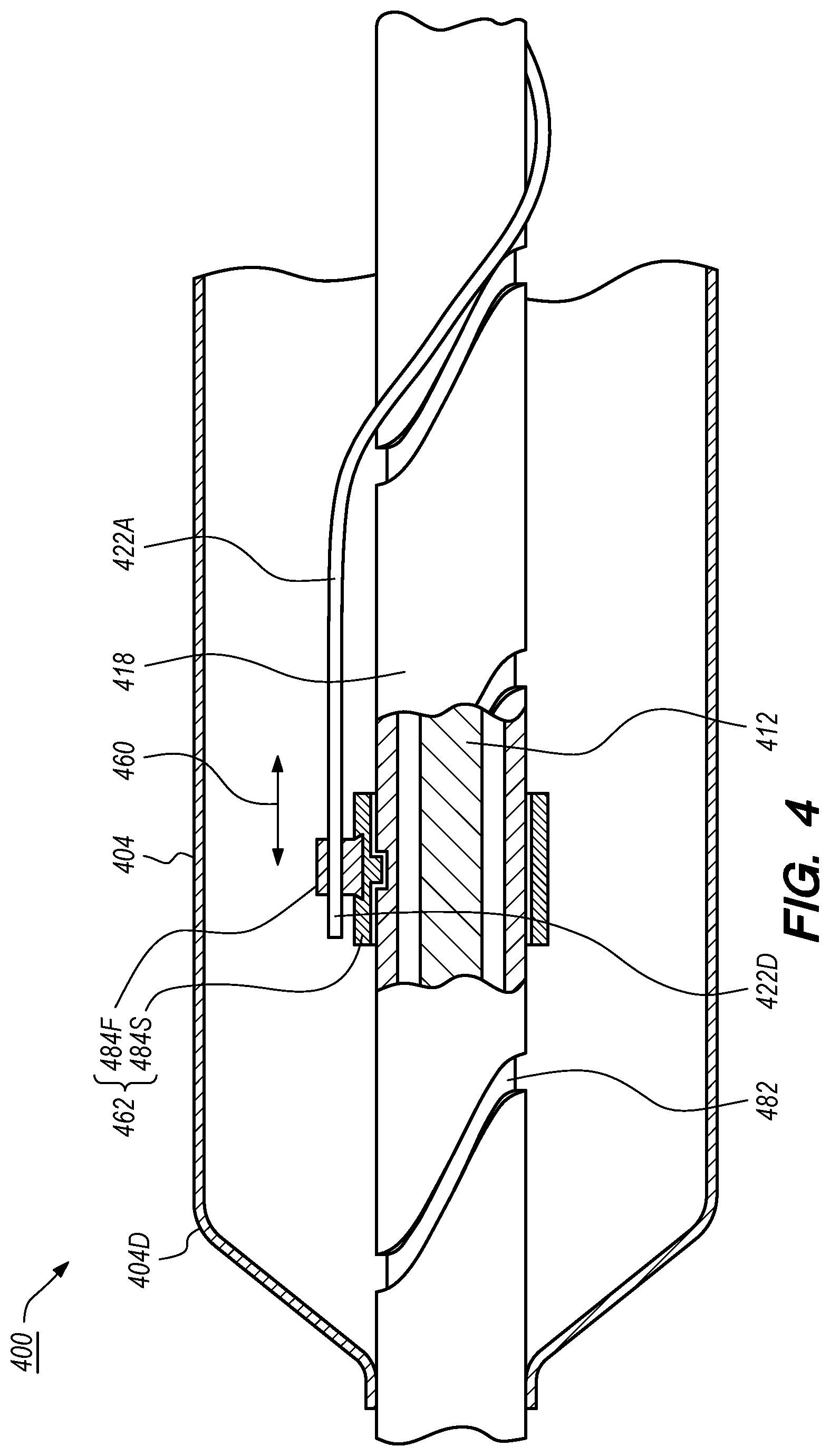 Patent US12102384 Figure 4 – Dynamic intravascular lithotripsy device with movable energy guide
