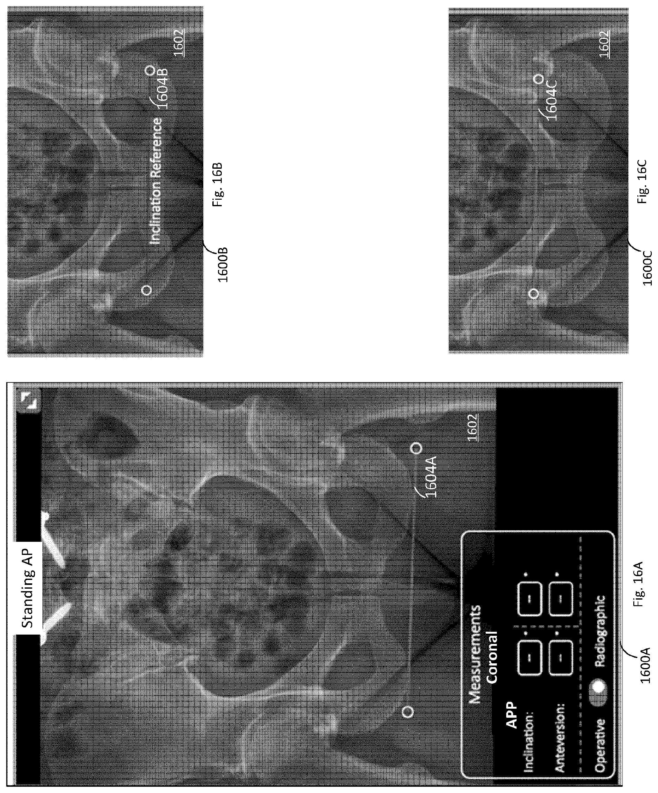 Patent US12102390 Figure 14 – System and method for pre-planning a procedure