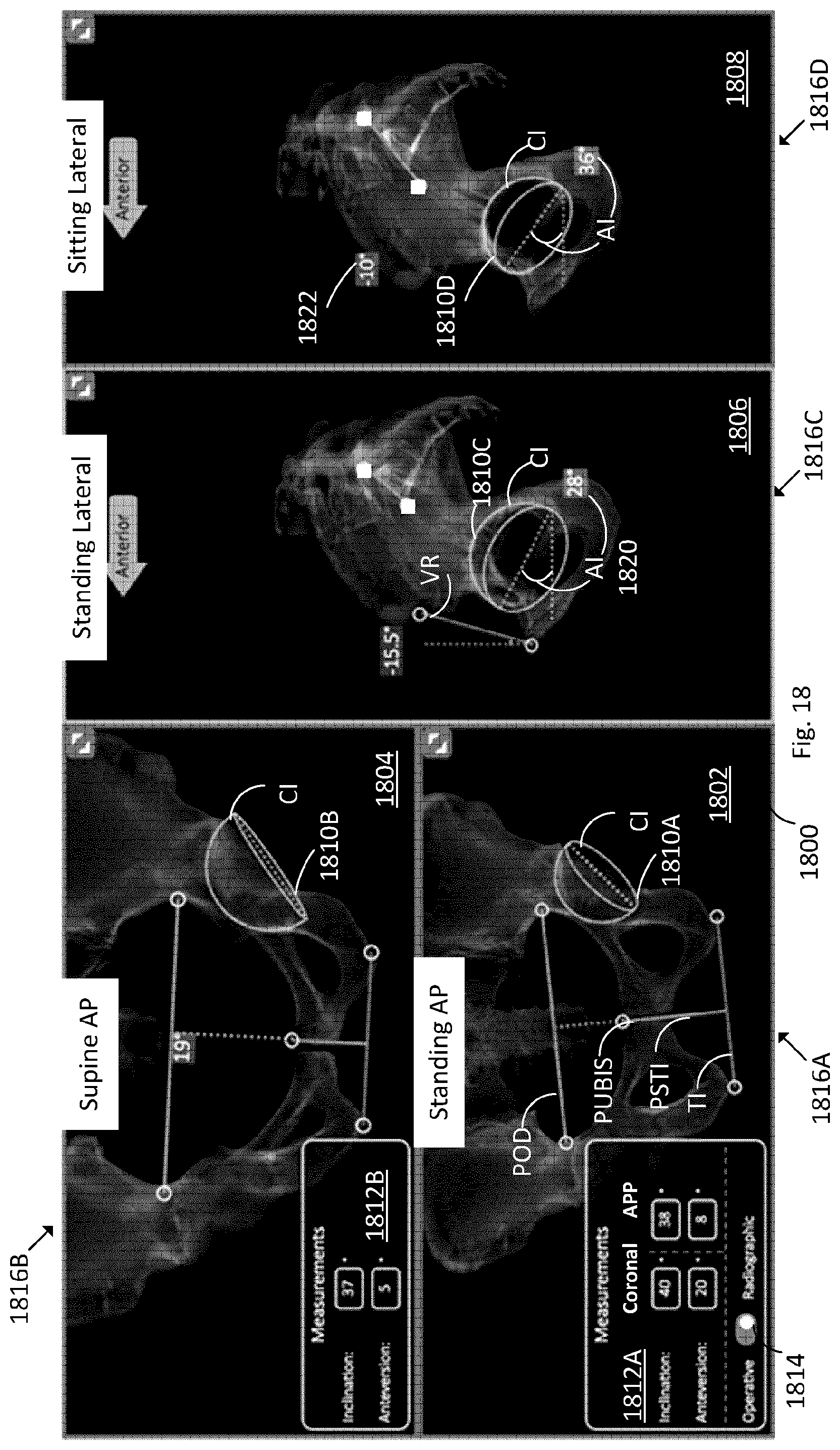 Patent US12102390 Figure 16 – System and method for pre-planning a procedure