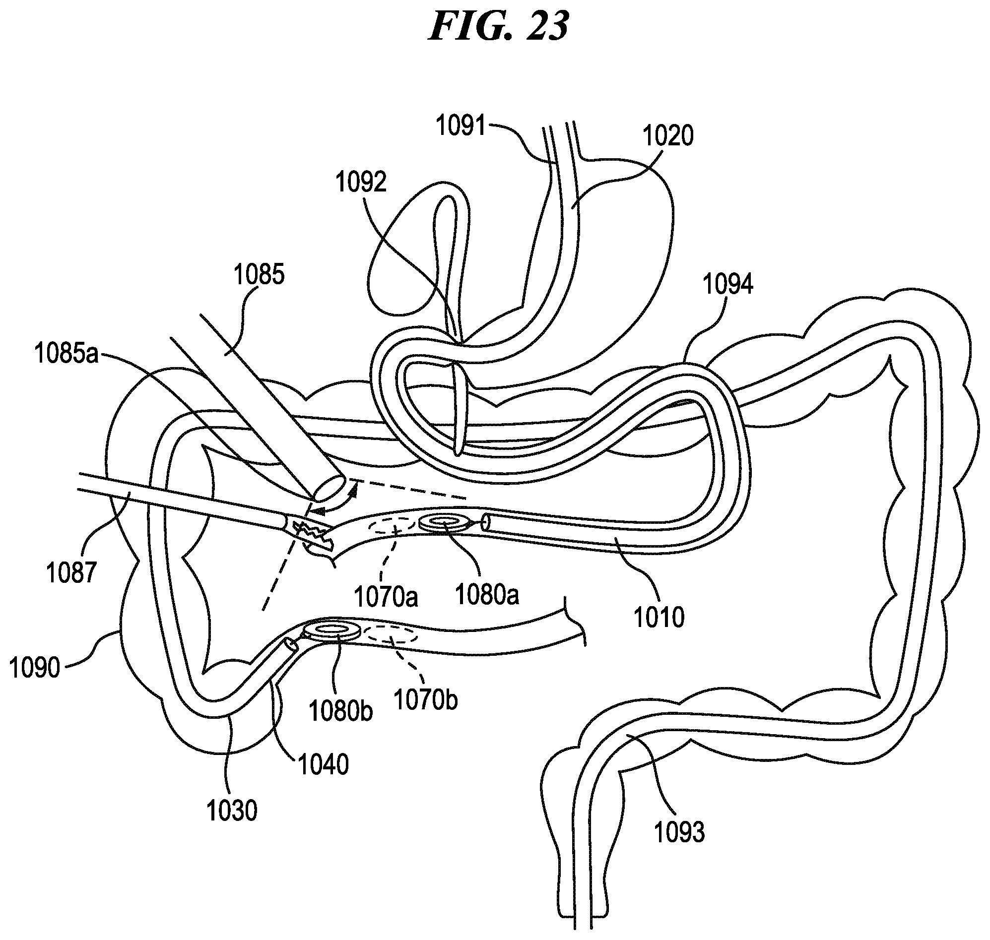 Patent US12102392 Figure 17 – Methods and systems for controlling cooperative surgical instruments