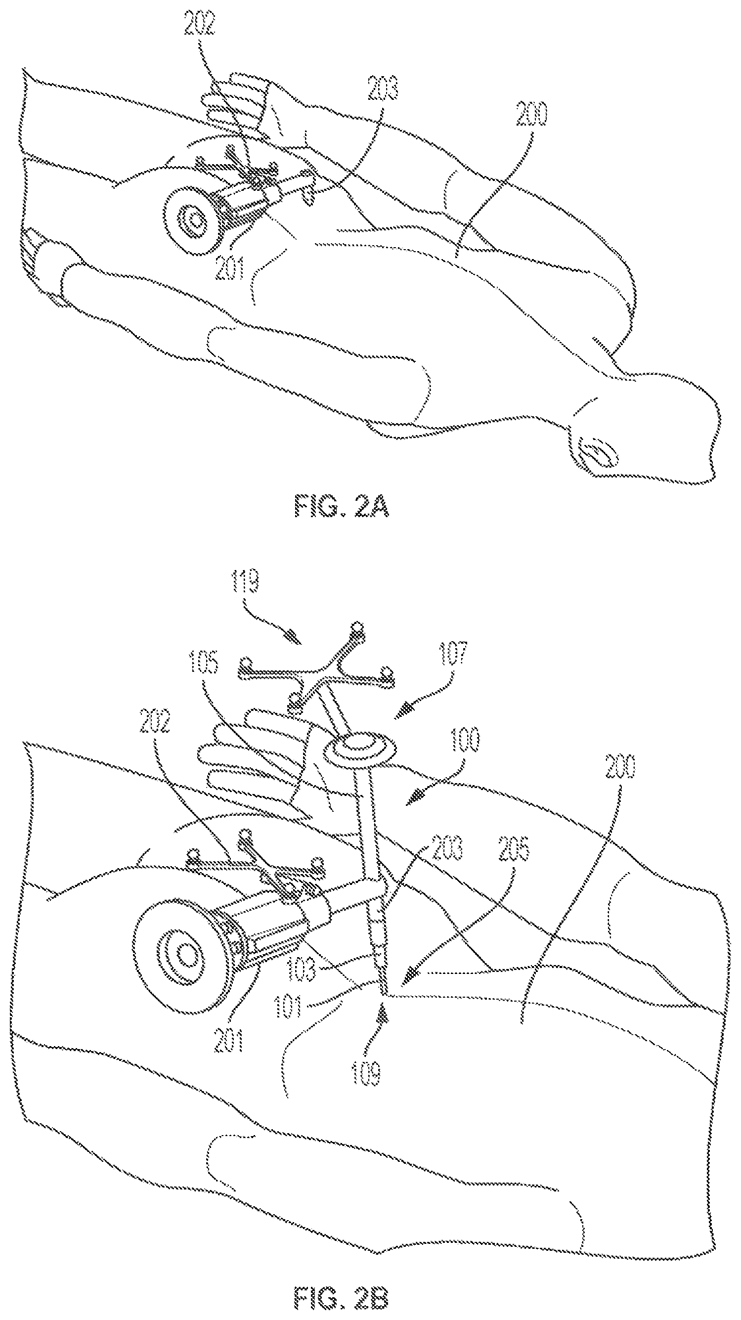 Patent US12102394 Figure 3 – Multi-stage dilator and cannula system and method