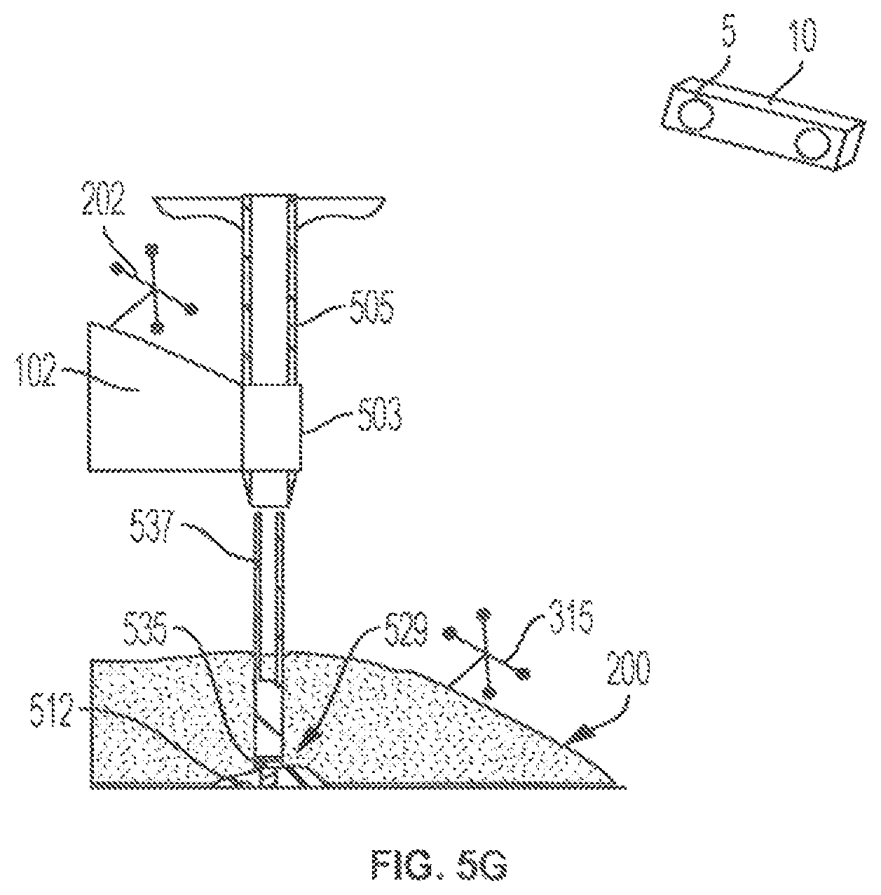 Patent US12102394 Figure 12 – Multi-stage dilator and cannula system and method