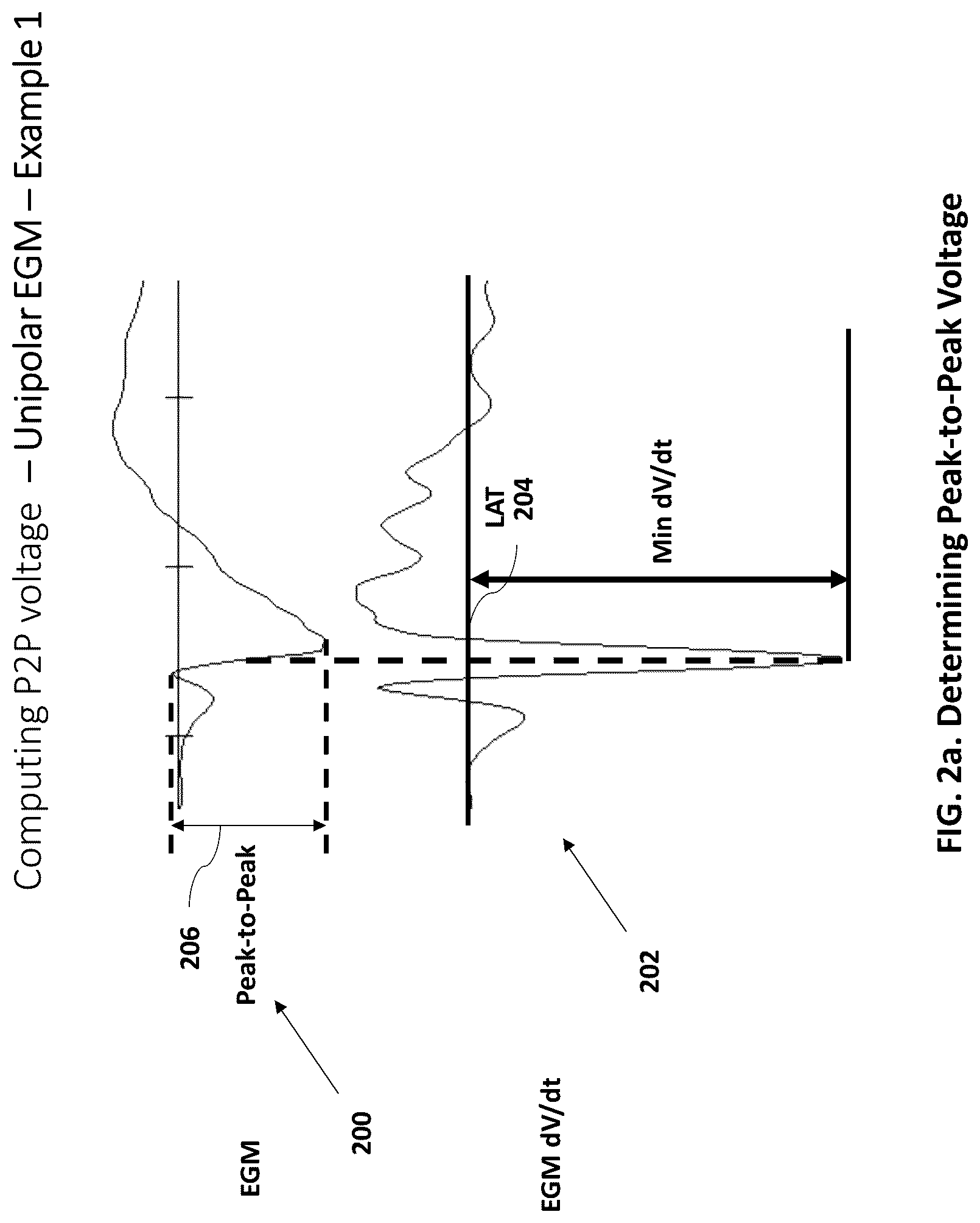 Patent US12102440 Figure 2 – Method and system for measuring cardiac electrogram depolarization voltage