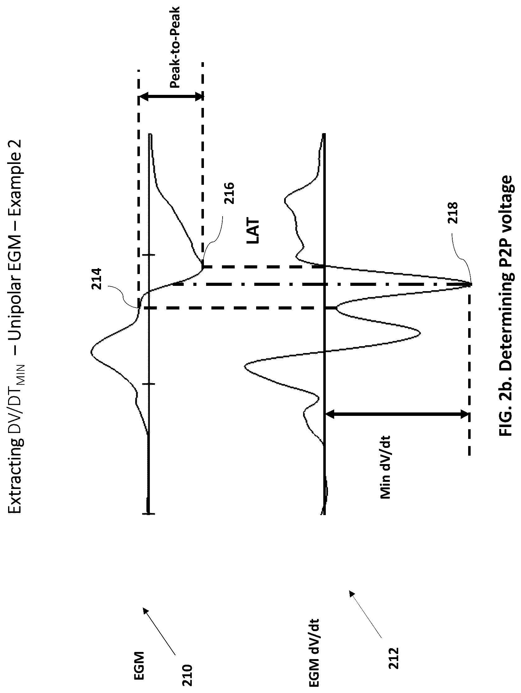 Patent US12102440 Figure 3 – Method and system for measuring cardiac electrogram depolarization voltage