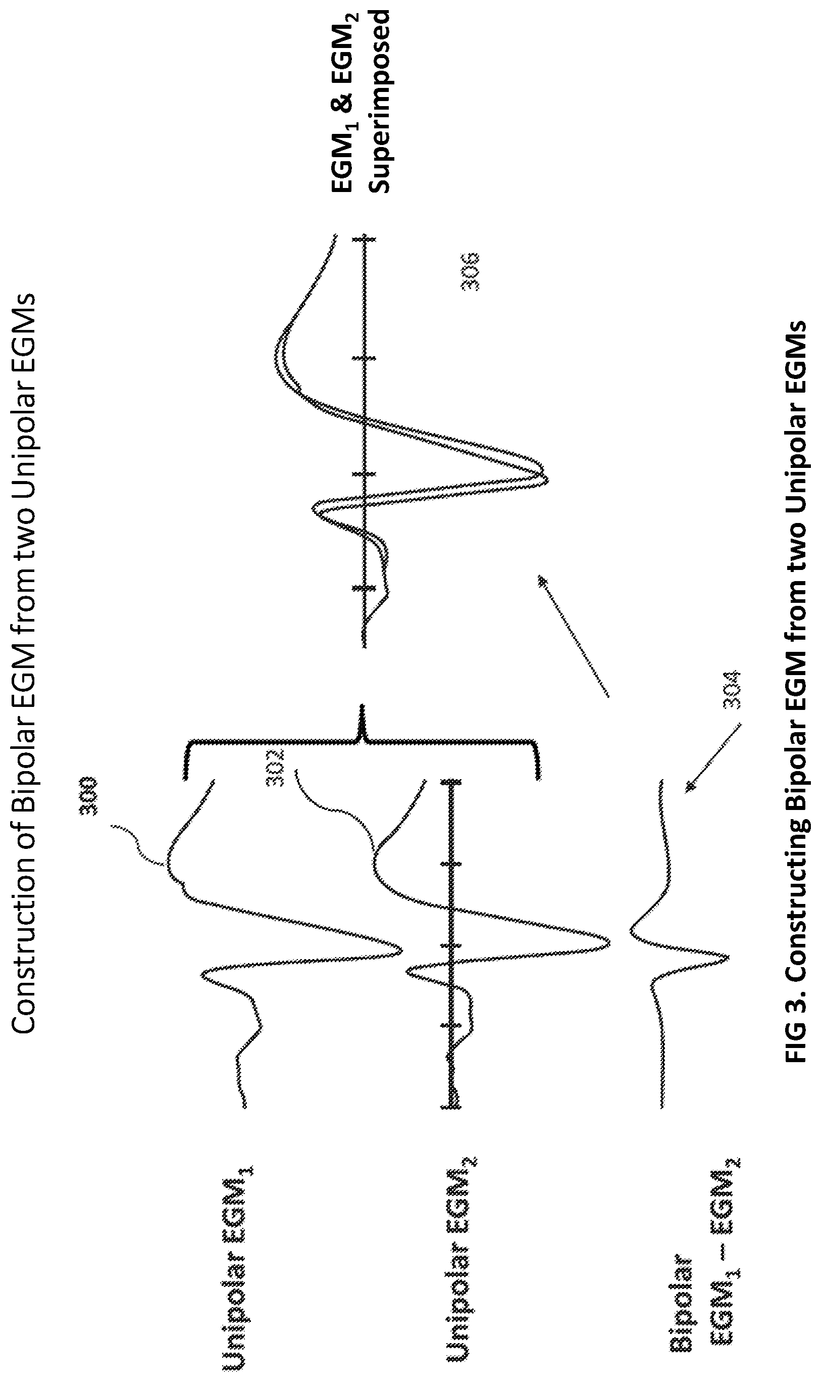 Patent US12102440 Figure 4 – Method and system for measuring cardiac electrogram depolarization voltage