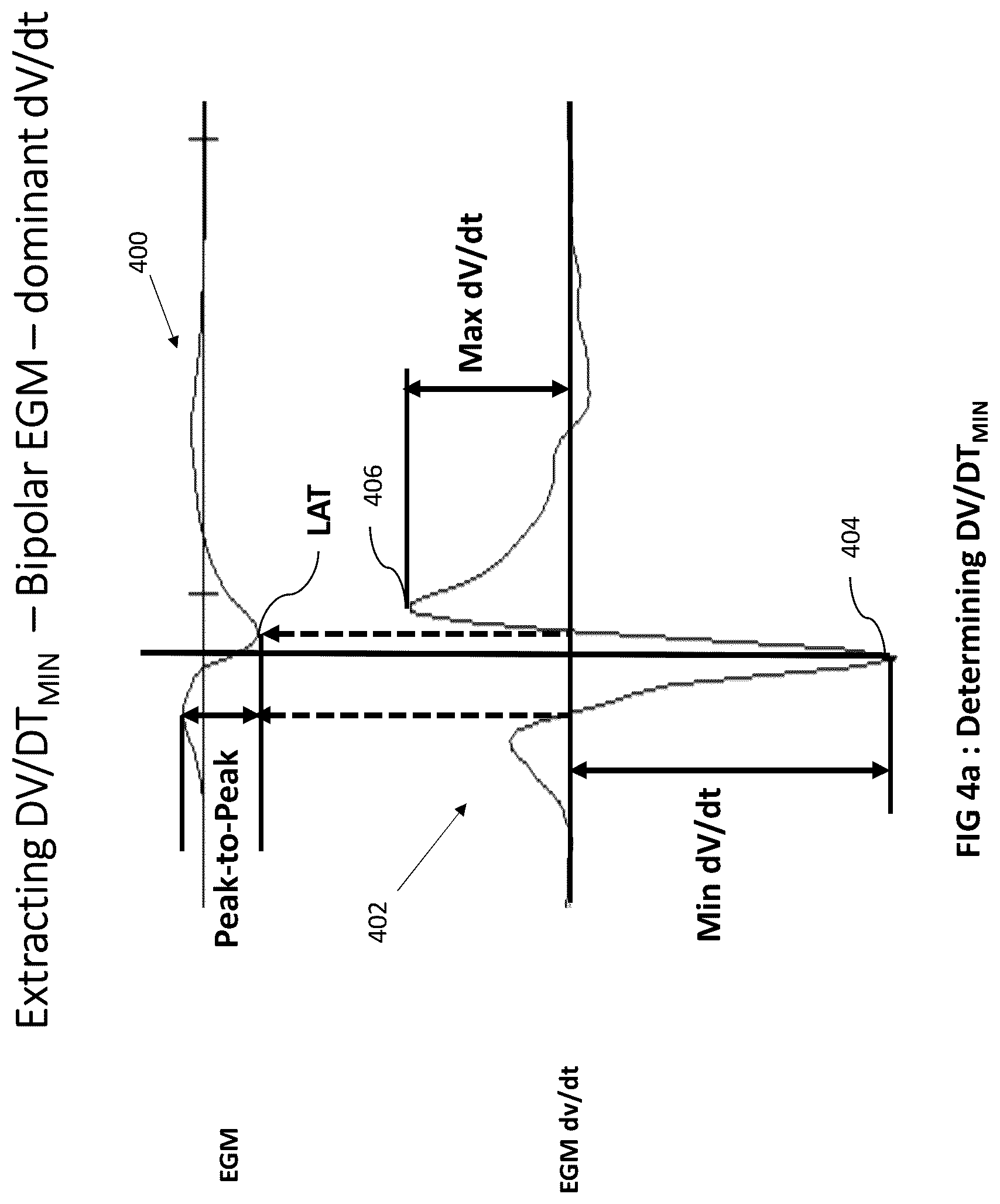 Patent US12102440 Figure 5 – Method and system for measuring cardiac electrogram depolarization voltage