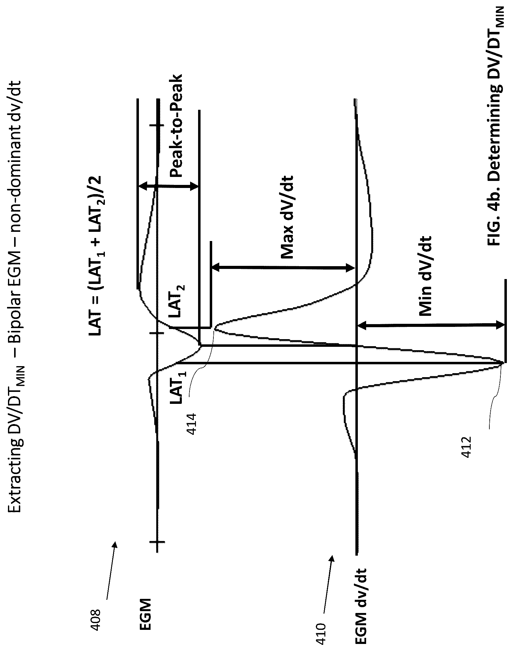 Patent US12102440 Figure 6 – Method and system for measuring cardiac electrogram depolarization voltage