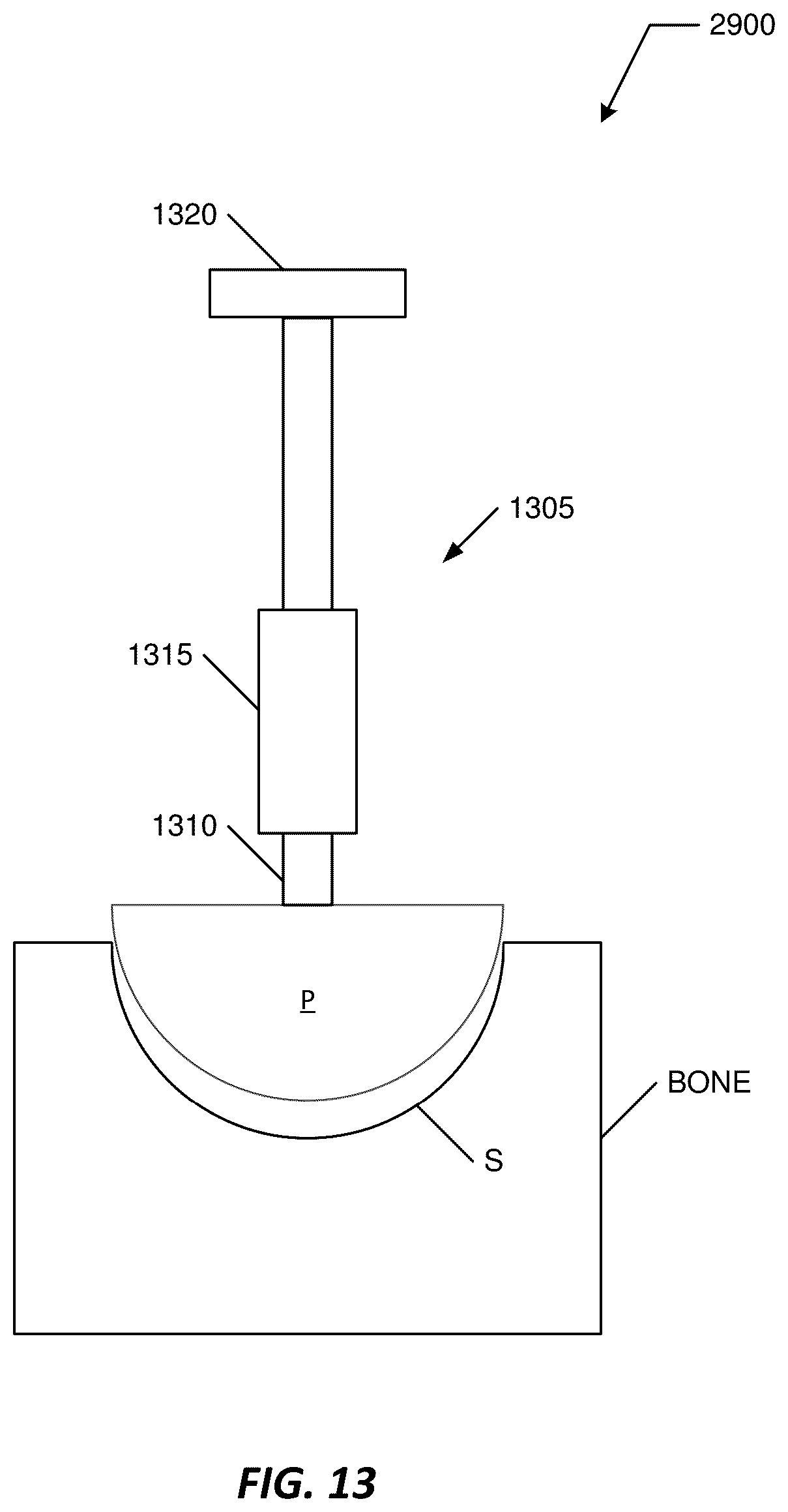 Patent US12102446 Figure 13 – Invasive sense measurement in prosthesis installation and bone preparation