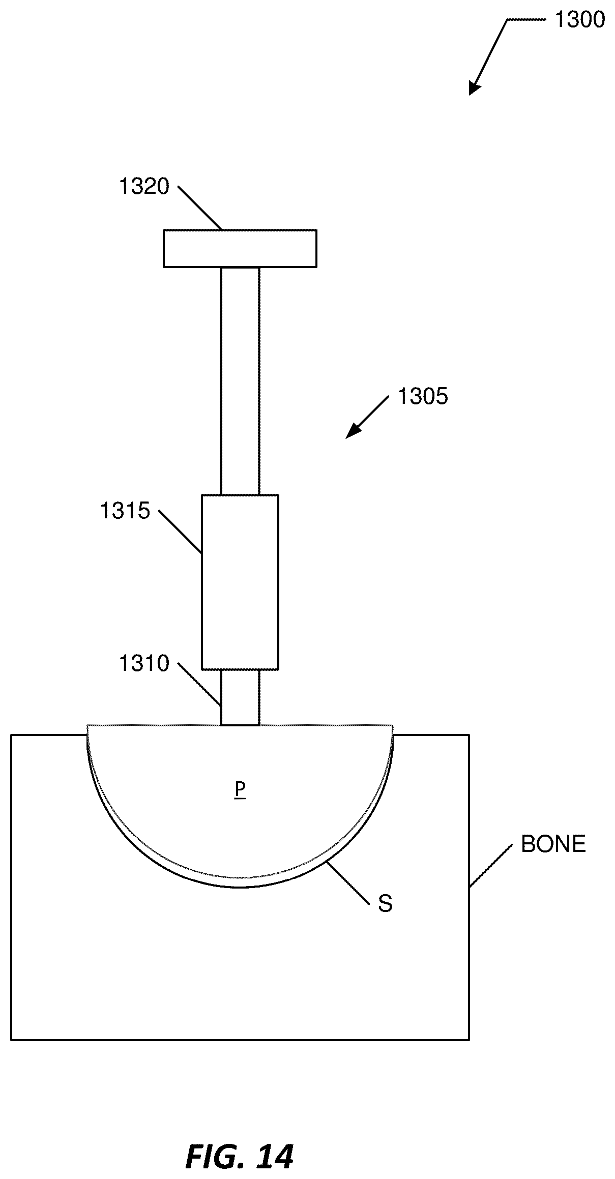 Patent US12102446 Figure 14 – Invasive sense measurement in prosthesis installation and bone preparation