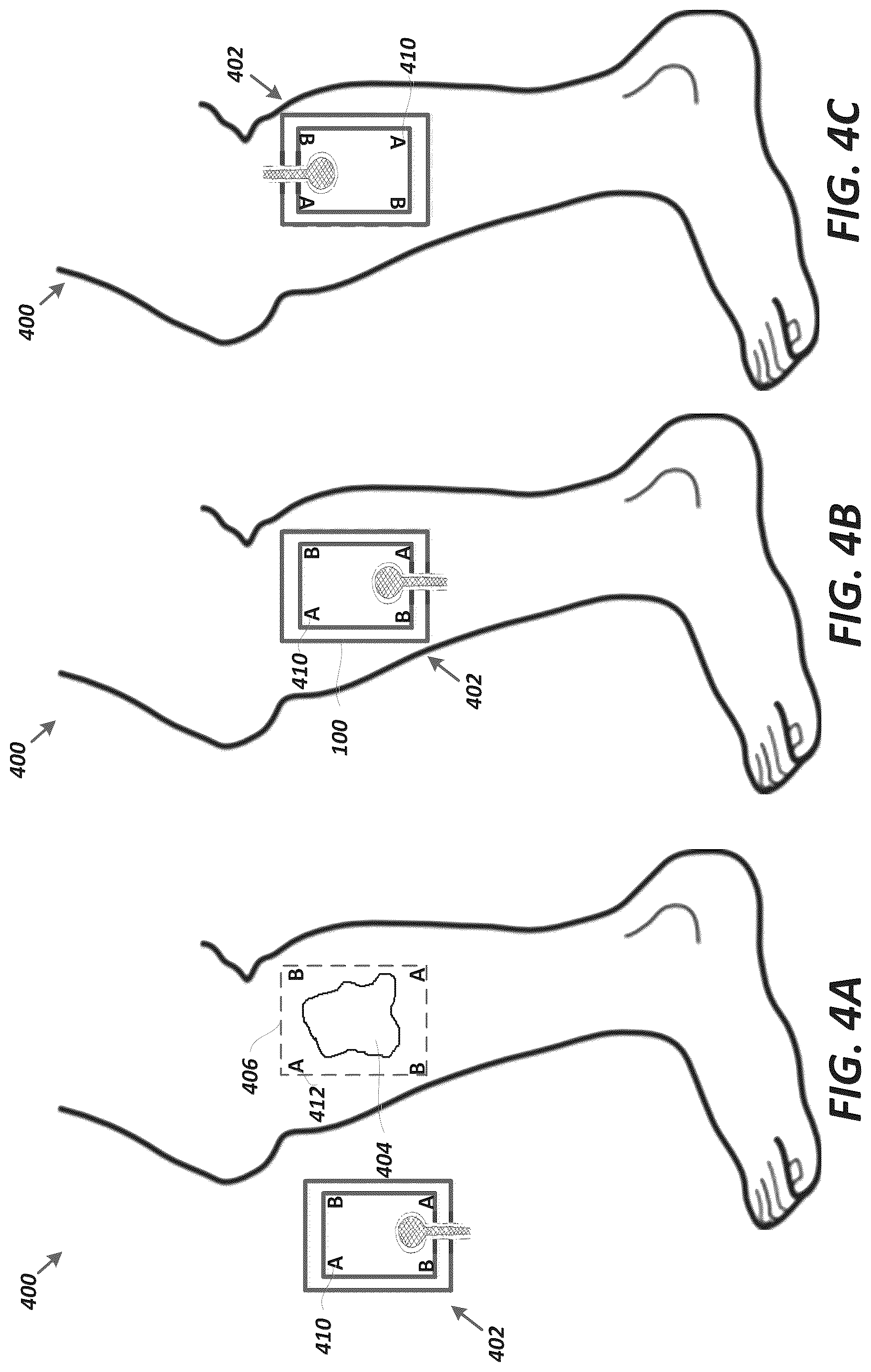 Patent US12102447 Figure 16 – Positioning of sensors for sensor enabled wound monitoring or therapy