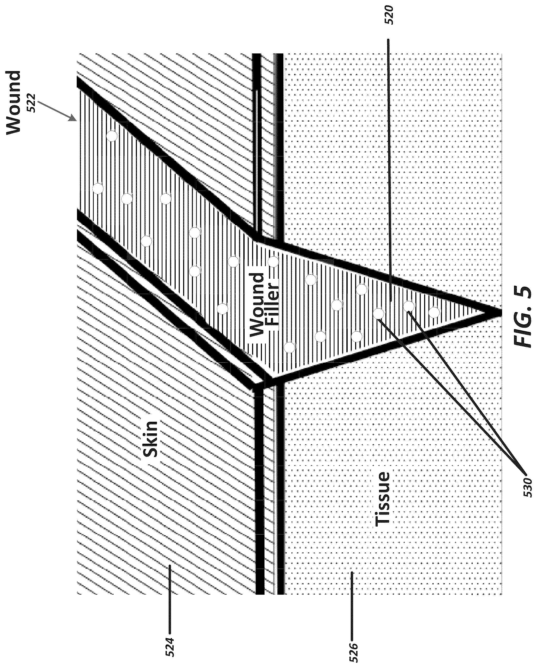 Patent US12102447 Figure 17 – Positioning of sensors for sensor enabled wound monitoring or therapy