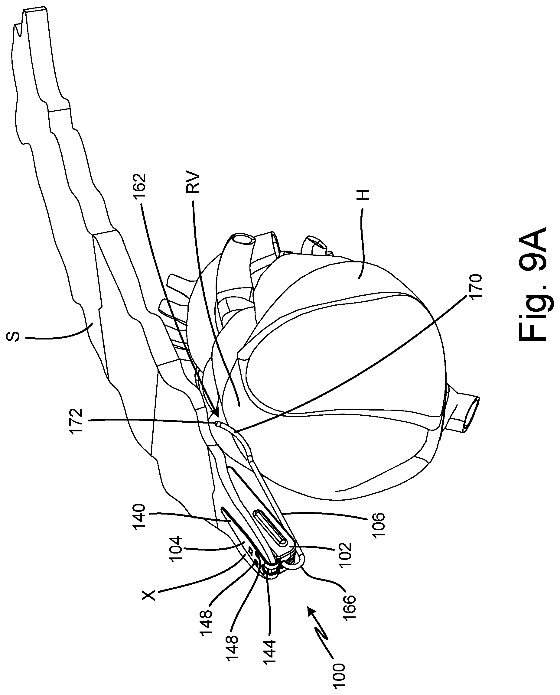Patent US12102449 Figure 11 – Clip design for a subcutaneous device