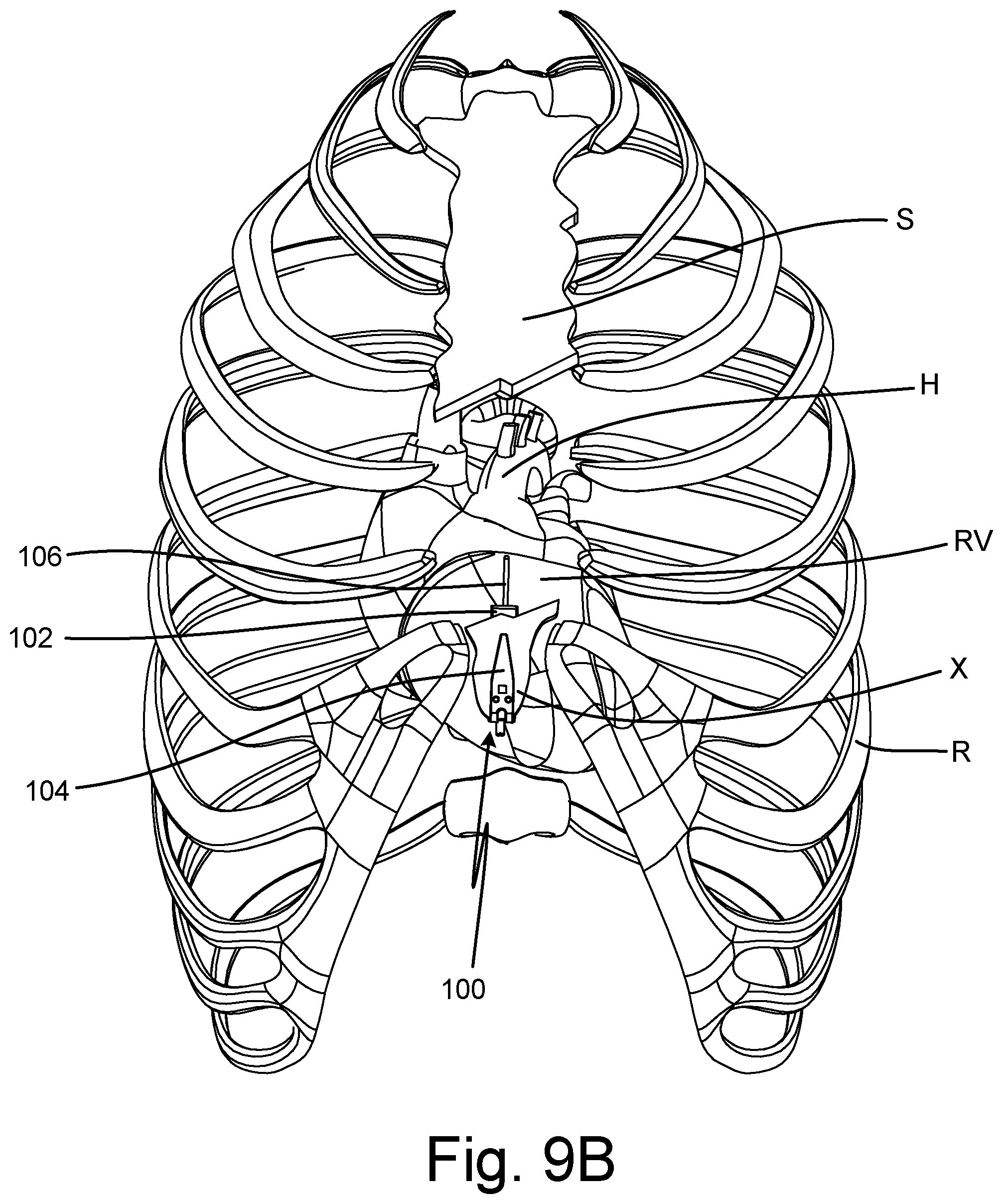 Patent US12102449 Figure 12 – Clip design for a subcutaneous device