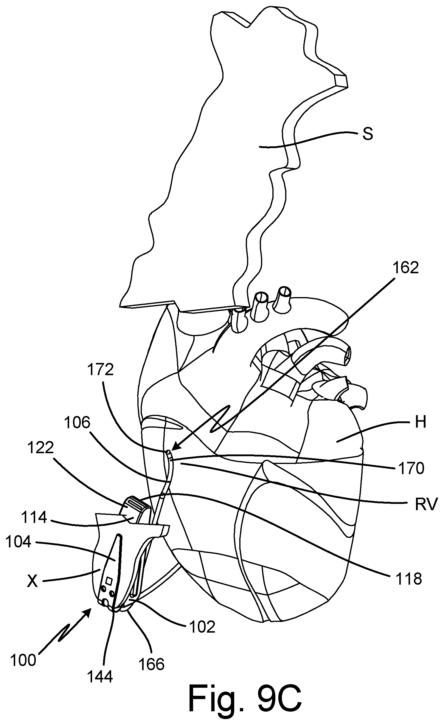 Patent US12102449 Figure 13 – Clip design for a subcutaneous device