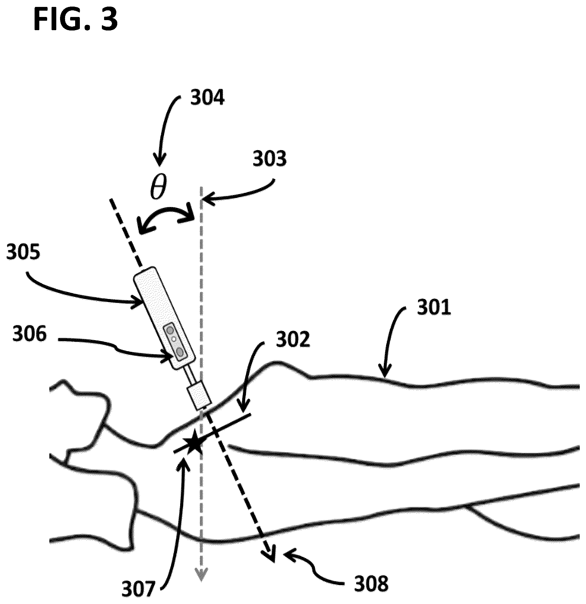 Patent US12102461 Figure 3 – Intraoperative radiation probe system with radiation-orientation mapping