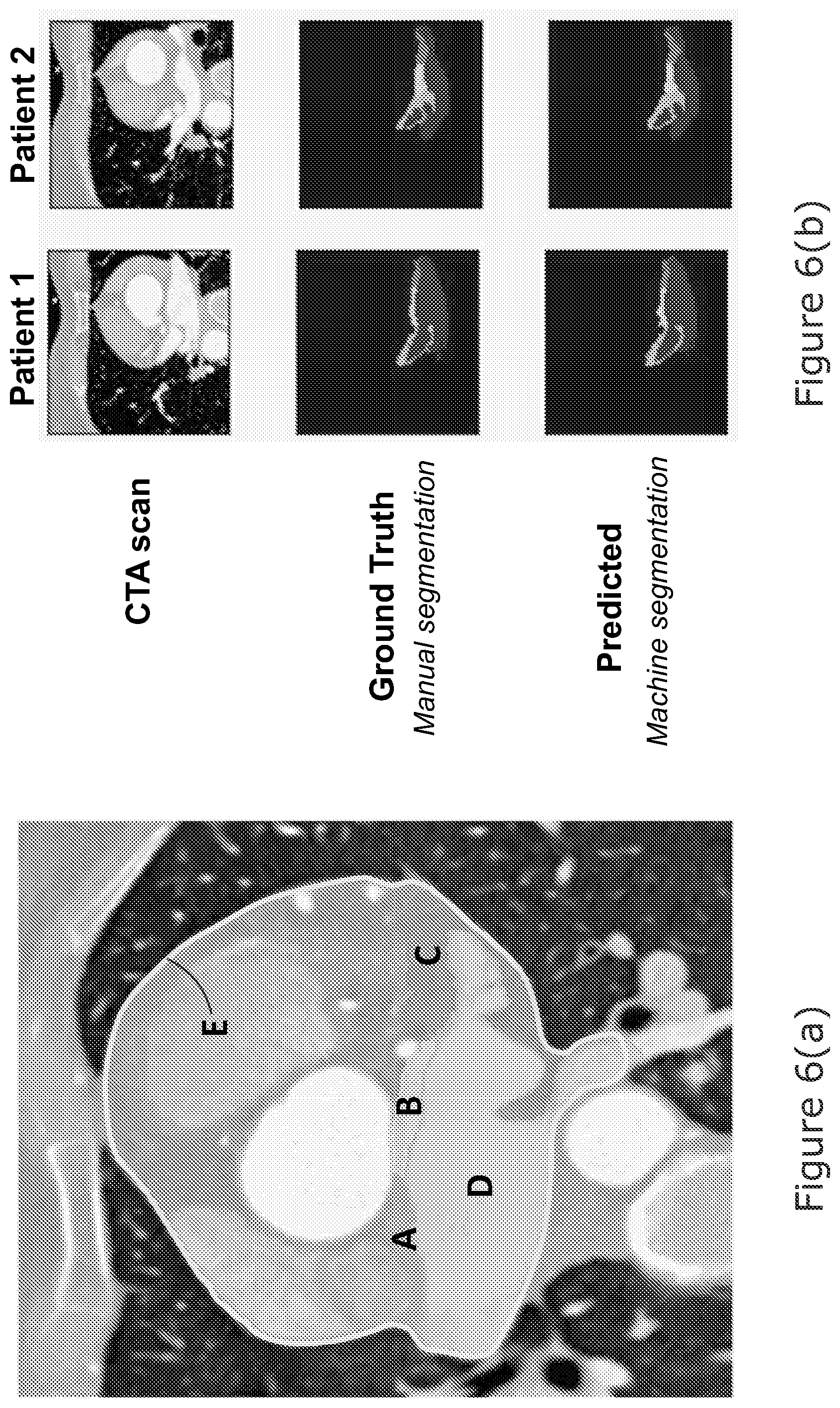 Patent US12102463 Figure 12 – Radiomic signature of an epicardial region