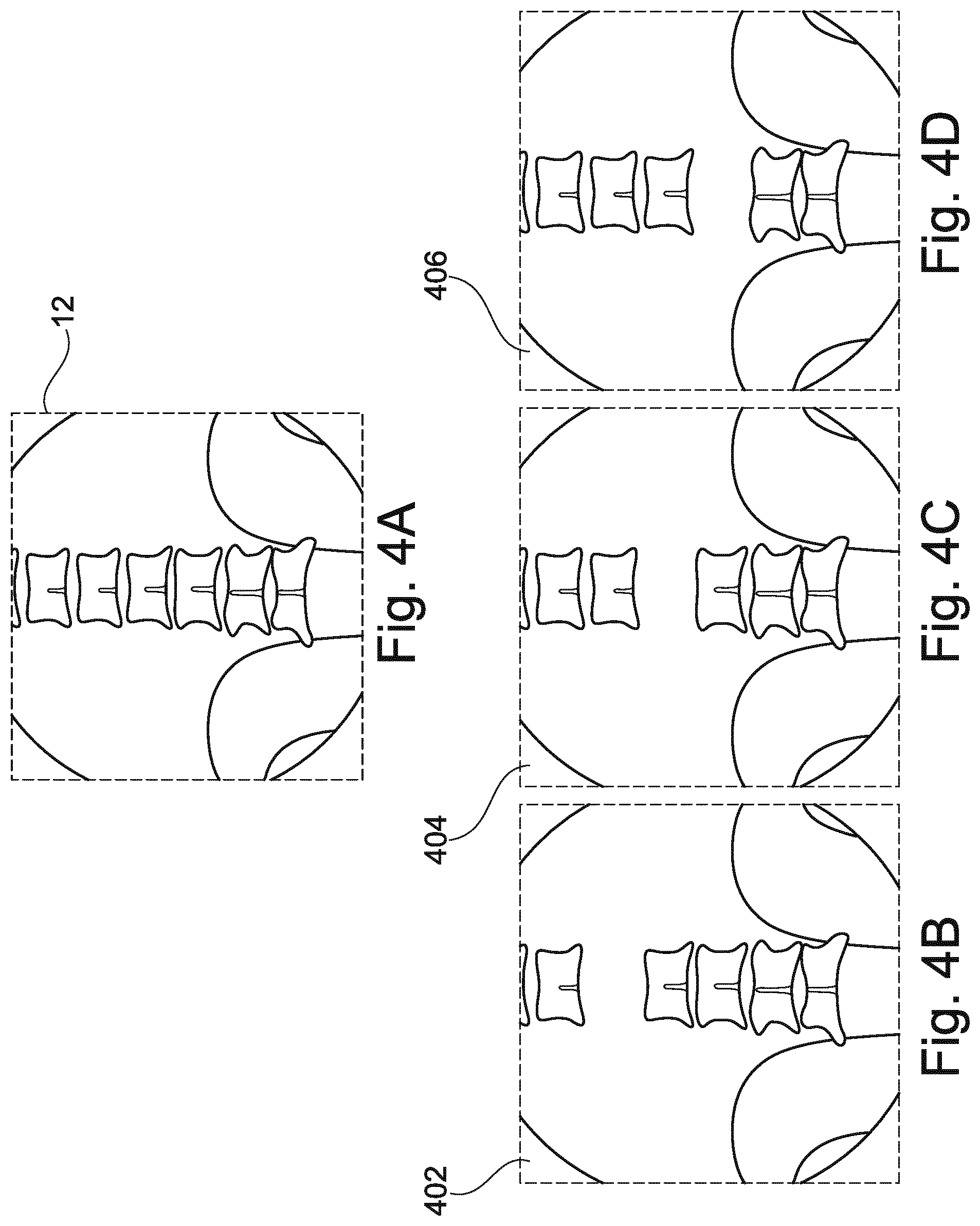 Patent US12102467 Figure 9 – Lung volume estimation from radiographic images